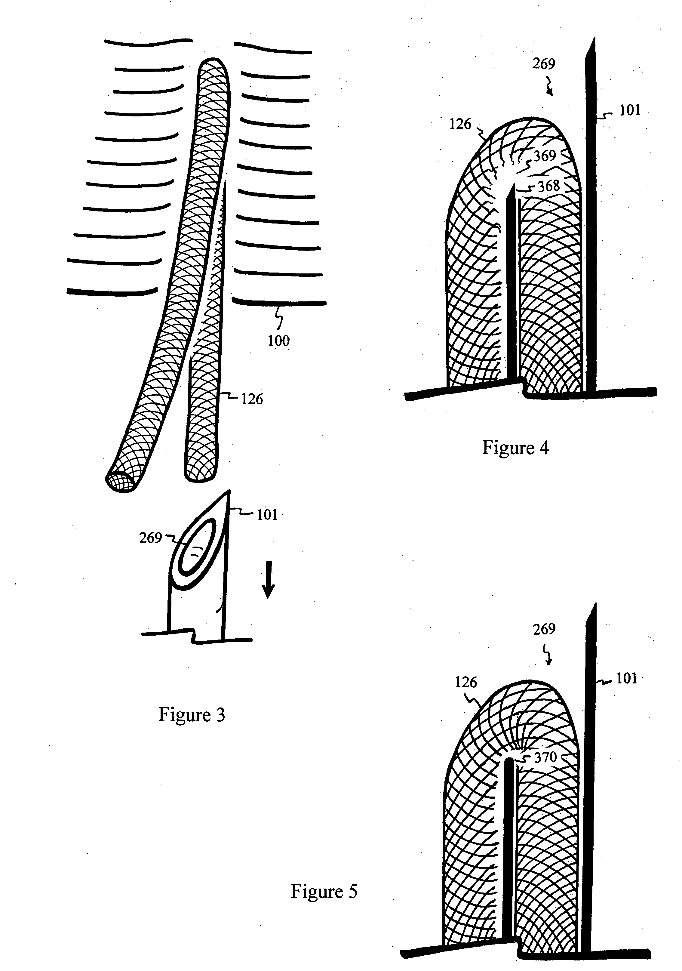 U-shaped disc shunt and delivery device