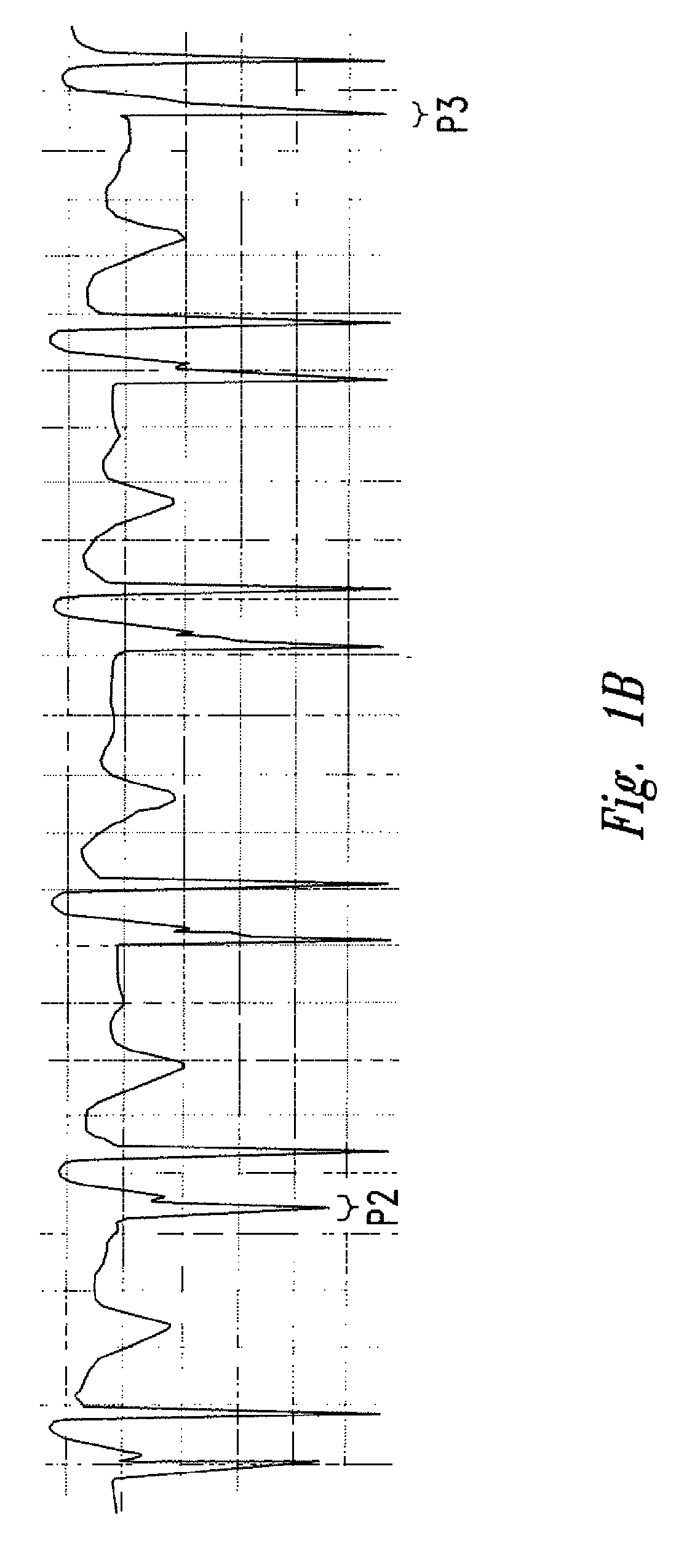 Method of locating the tip of a central venous catheter