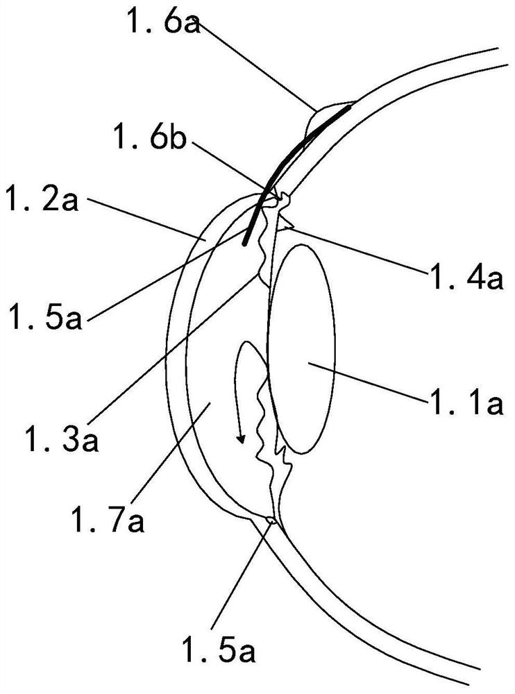 A pre-type adjustable electromagnetic drainage valve for treating glaucoma