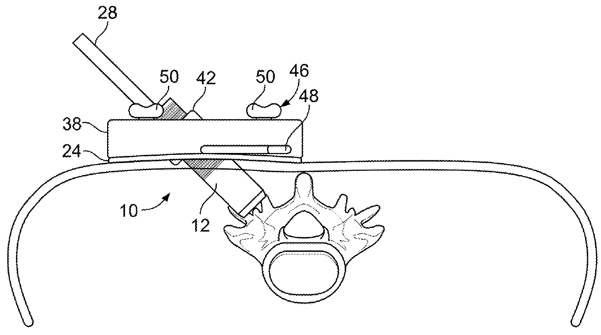 Minimal Impact Access System To Disc Space