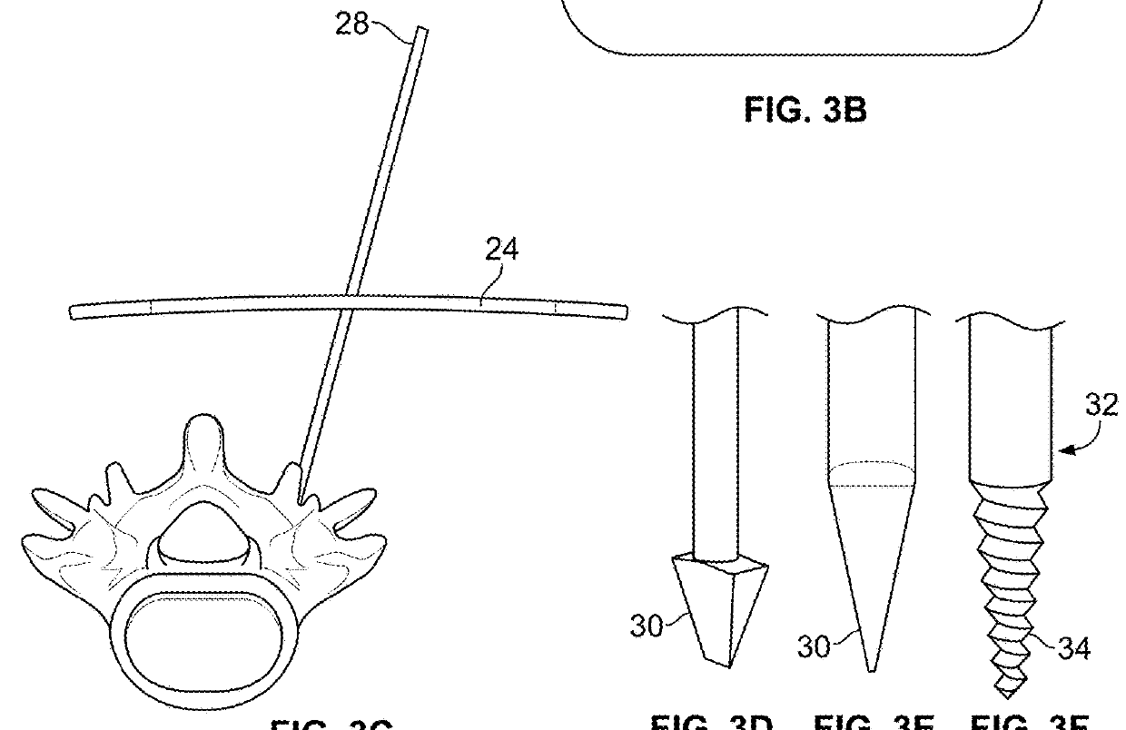 Minimal Impact Access System To Disc Space