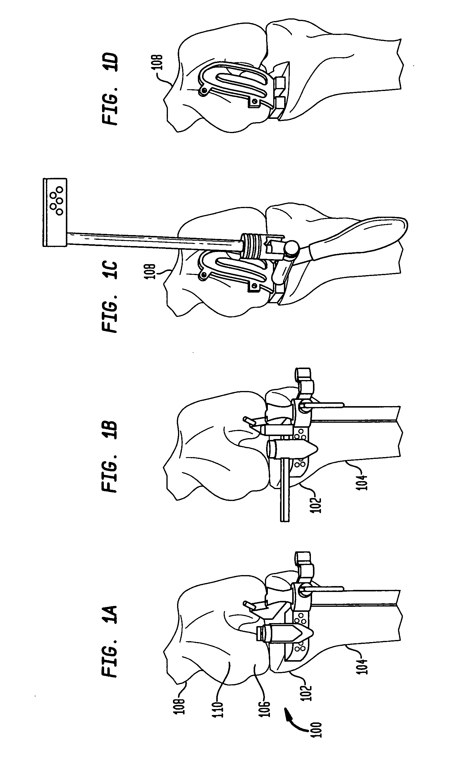 Unicondylar knee implants and insertion methods therefor