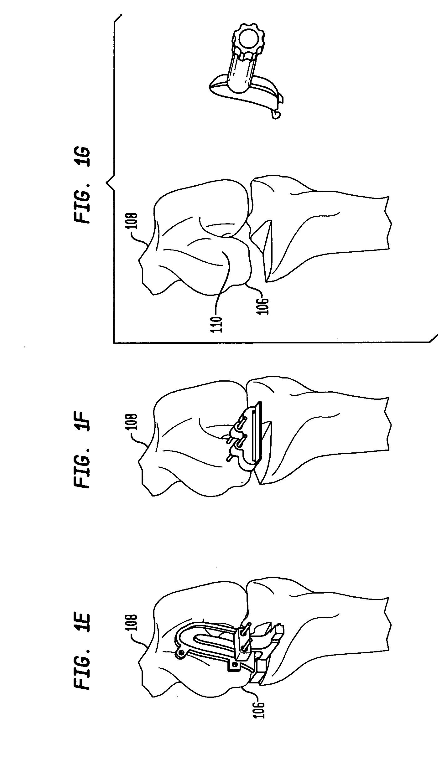 Unicondylar knee implants and insertion methods therefor