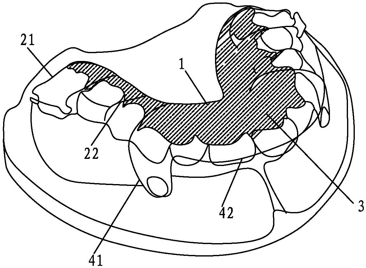 Pull-out type orthodontic device