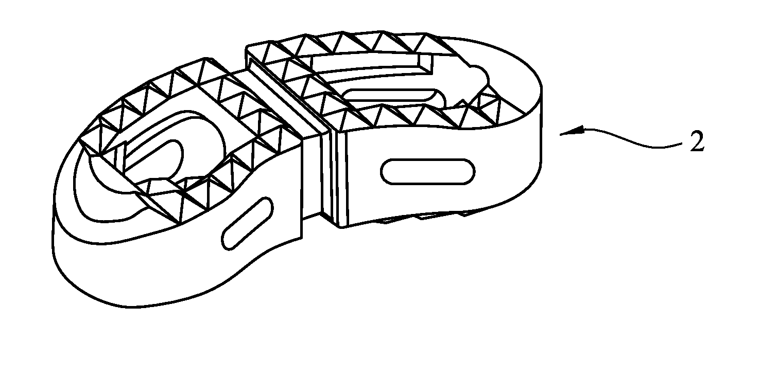 Method for Manufacturing a Medical Implant With a Radiopaque Marker