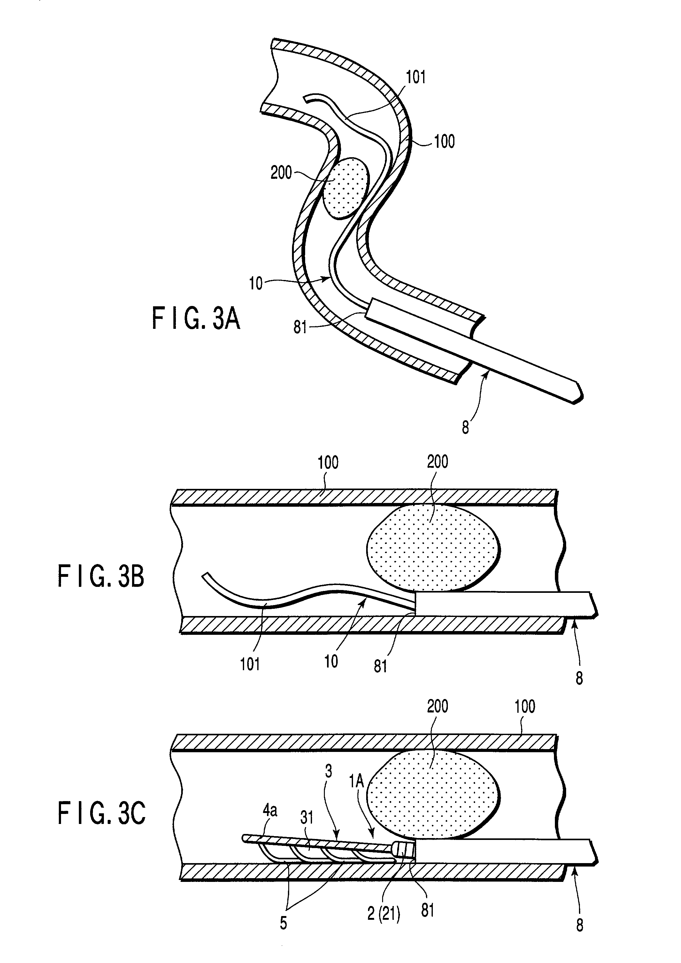 Intravascular obstruction removing wire and medical instrument