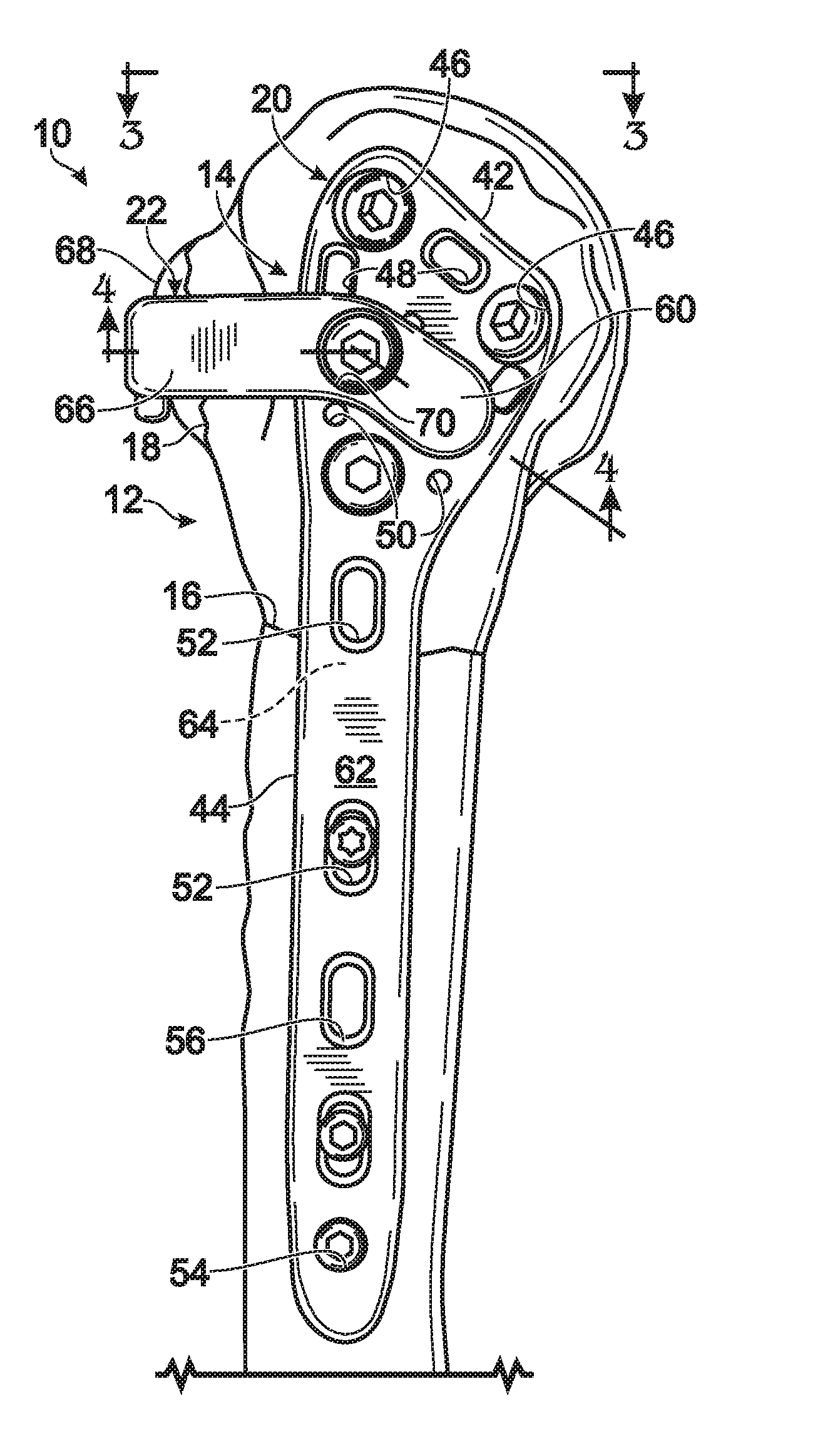 Expanded fixation of bones