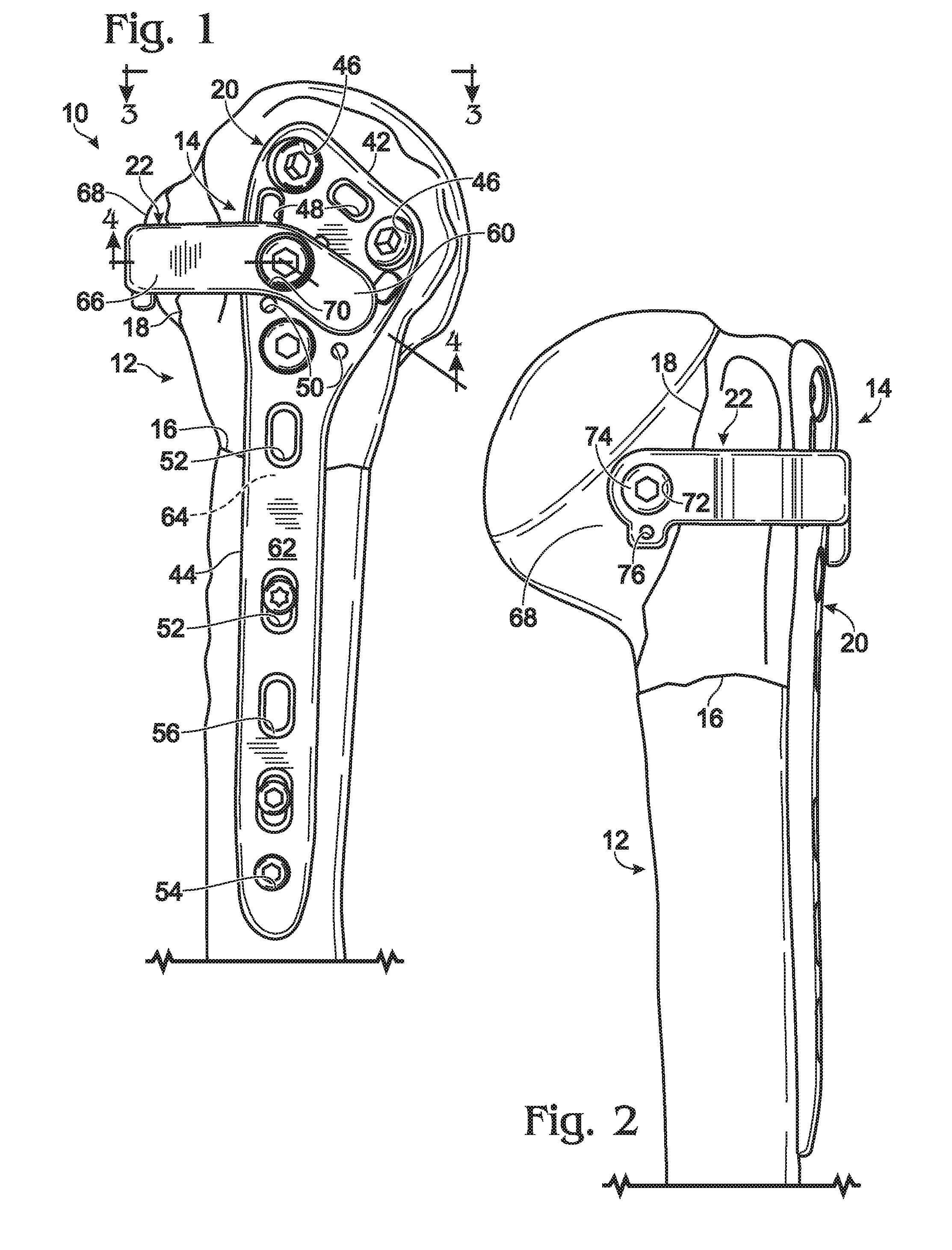 Expanded fixation of bones