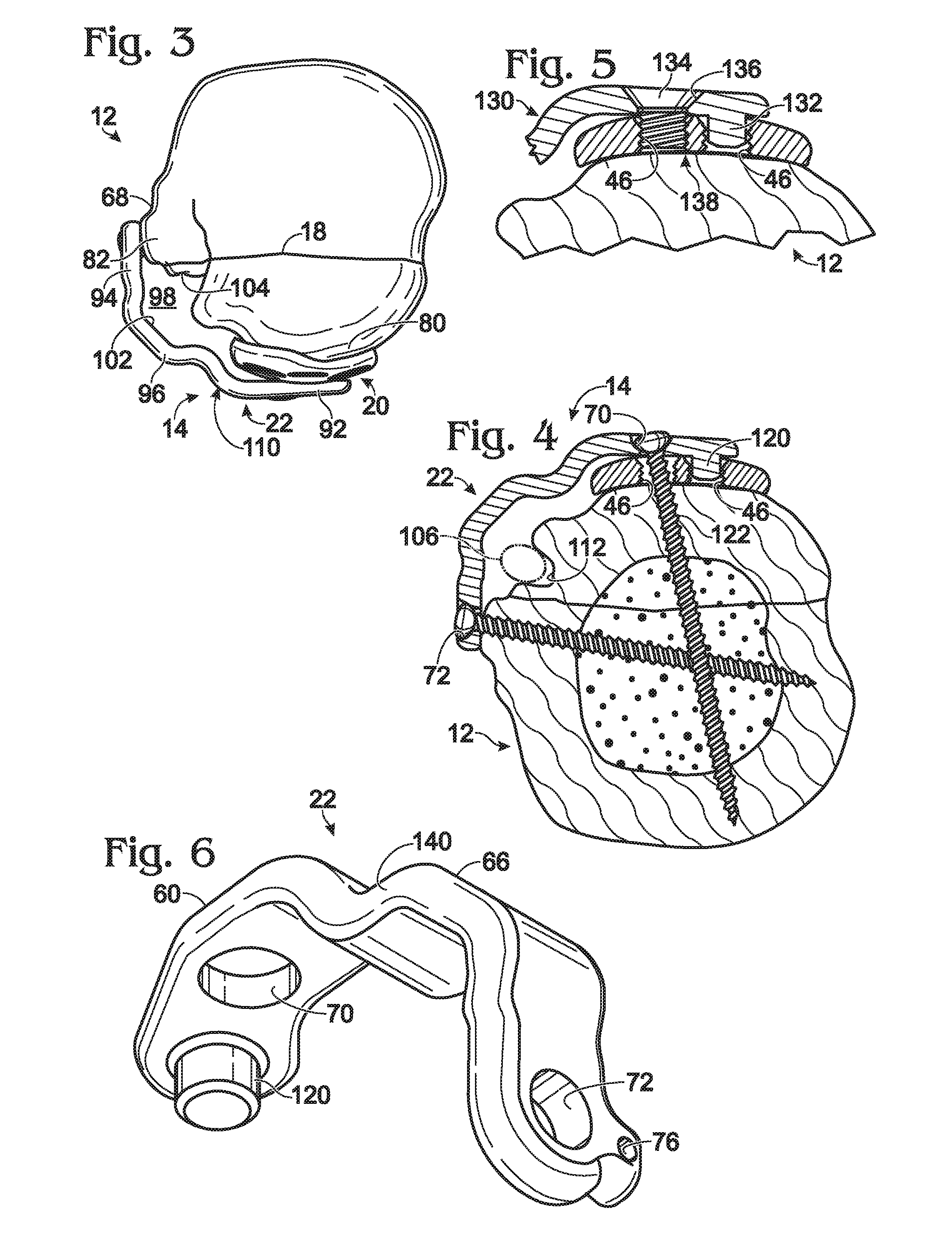 Expanded fixation of bones