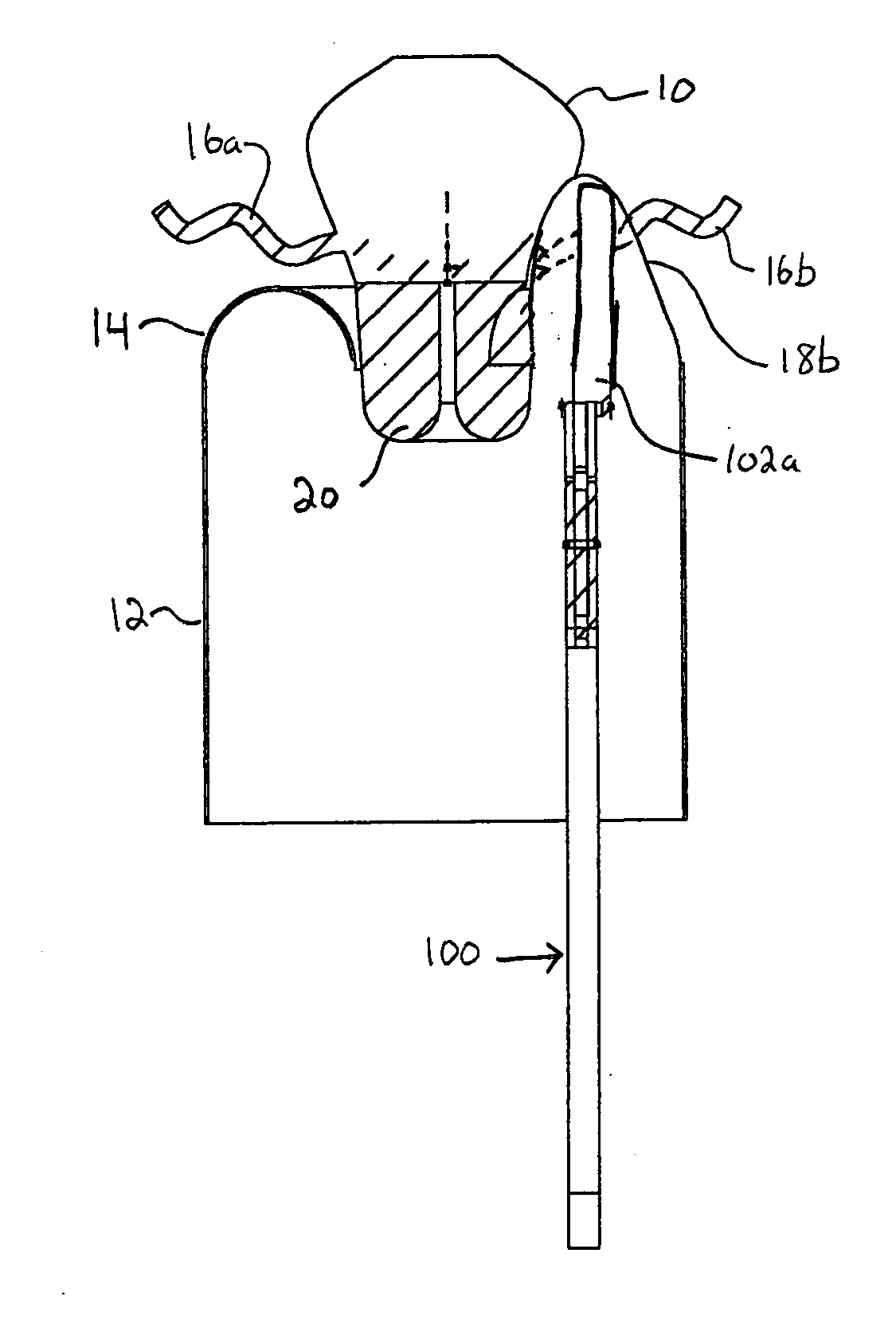 Methods for minimally-invasive, non-permanent occlusion of a uterine artery