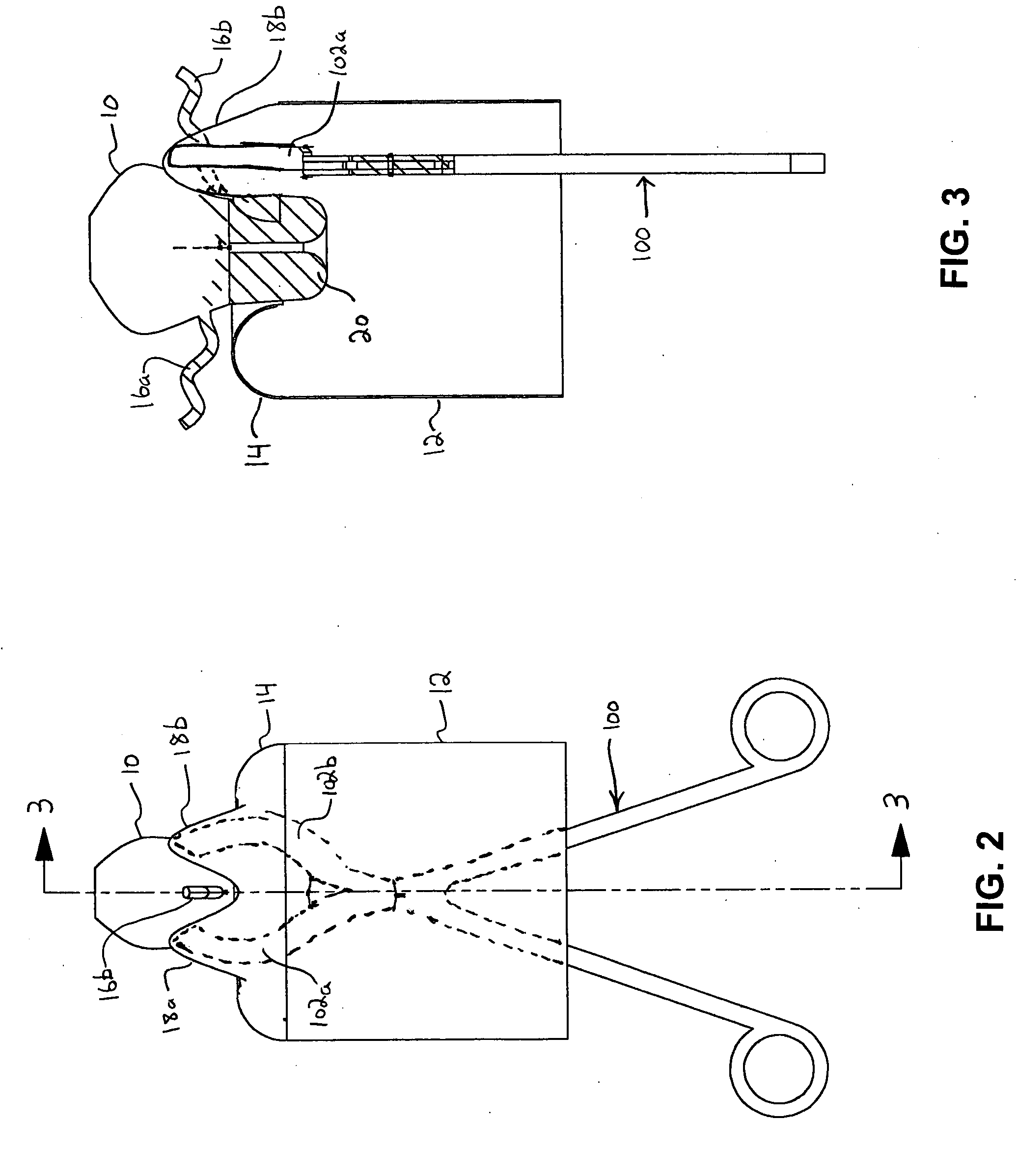 Methods for minimally-invasive, non-permanent occlusion of a uterine artery