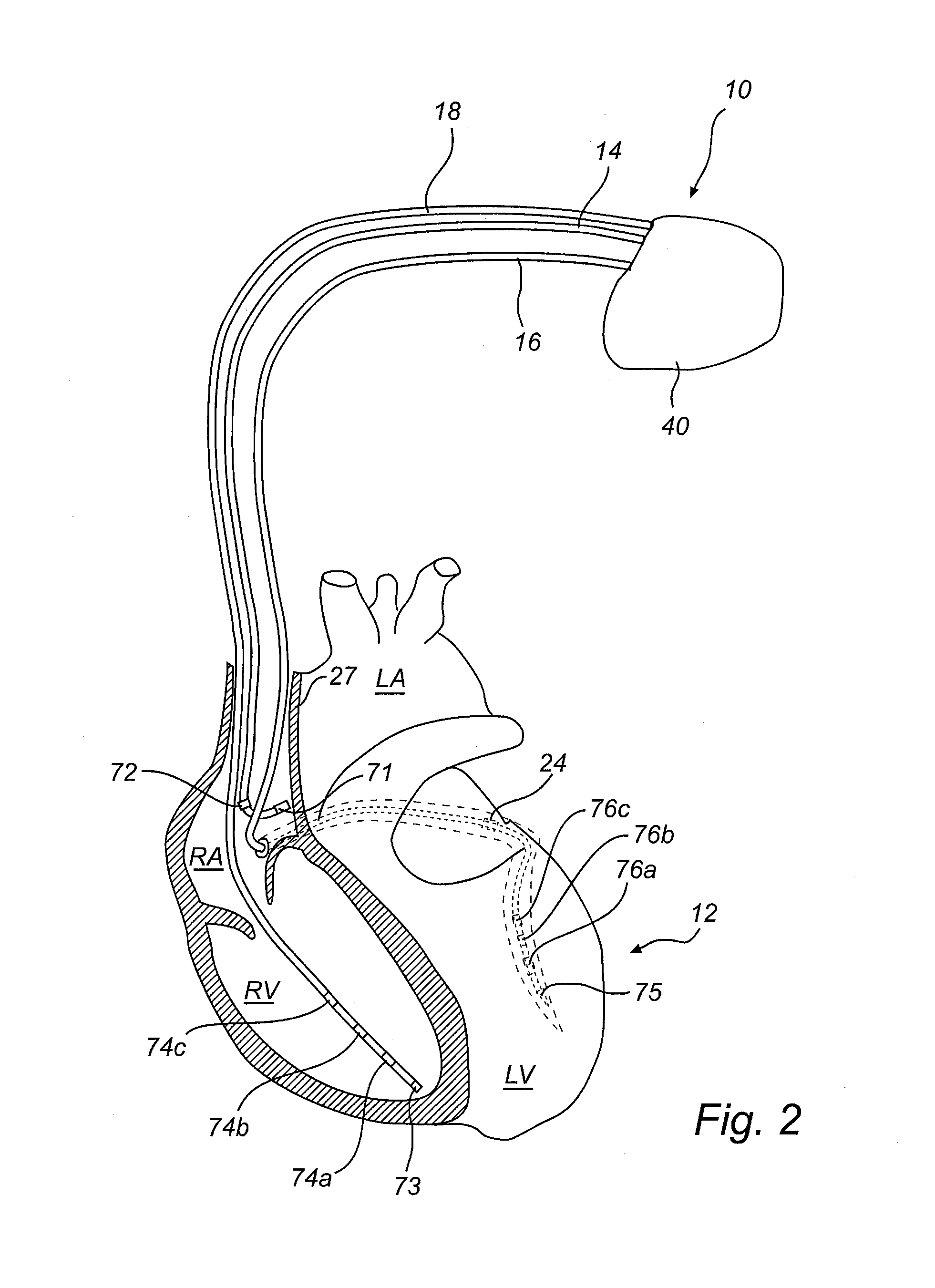 Detection and reduction of phrenic nerve stimulation