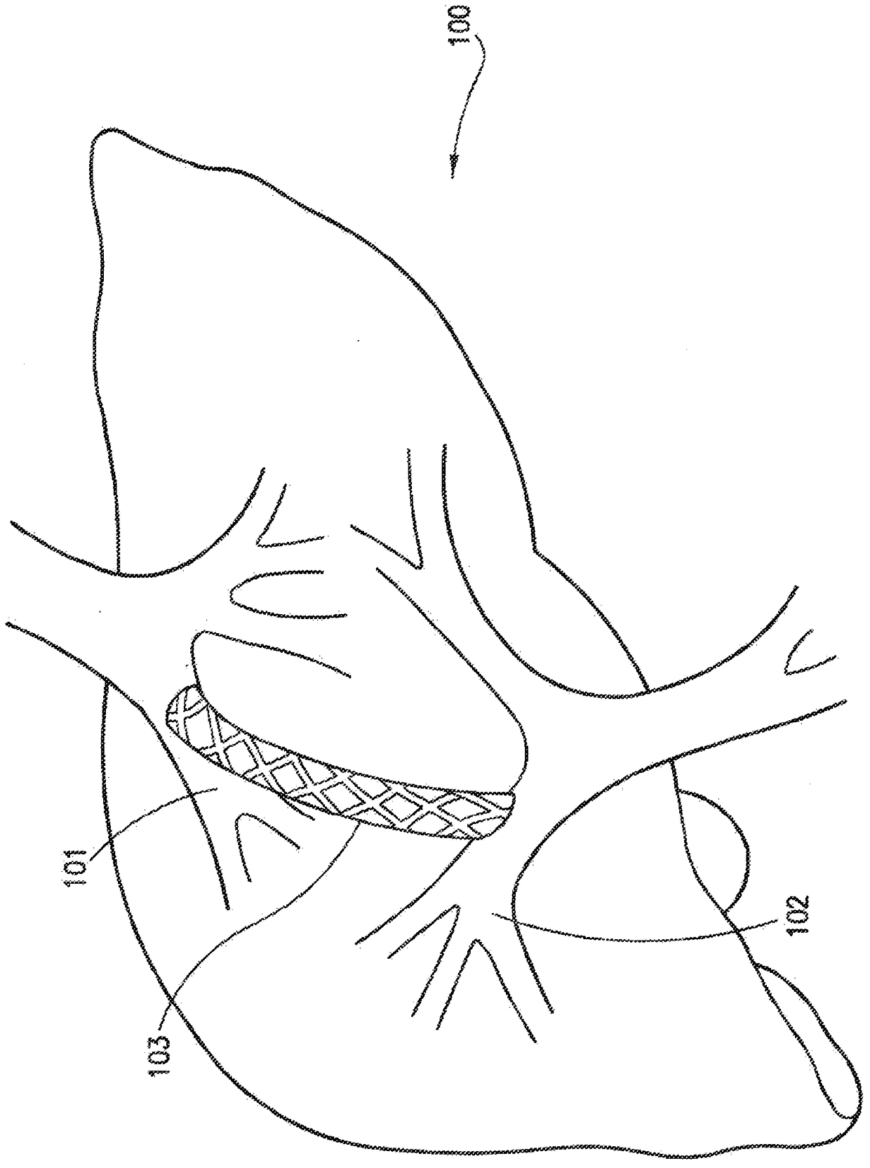 transjugular intrahepatic portosystemic shunt