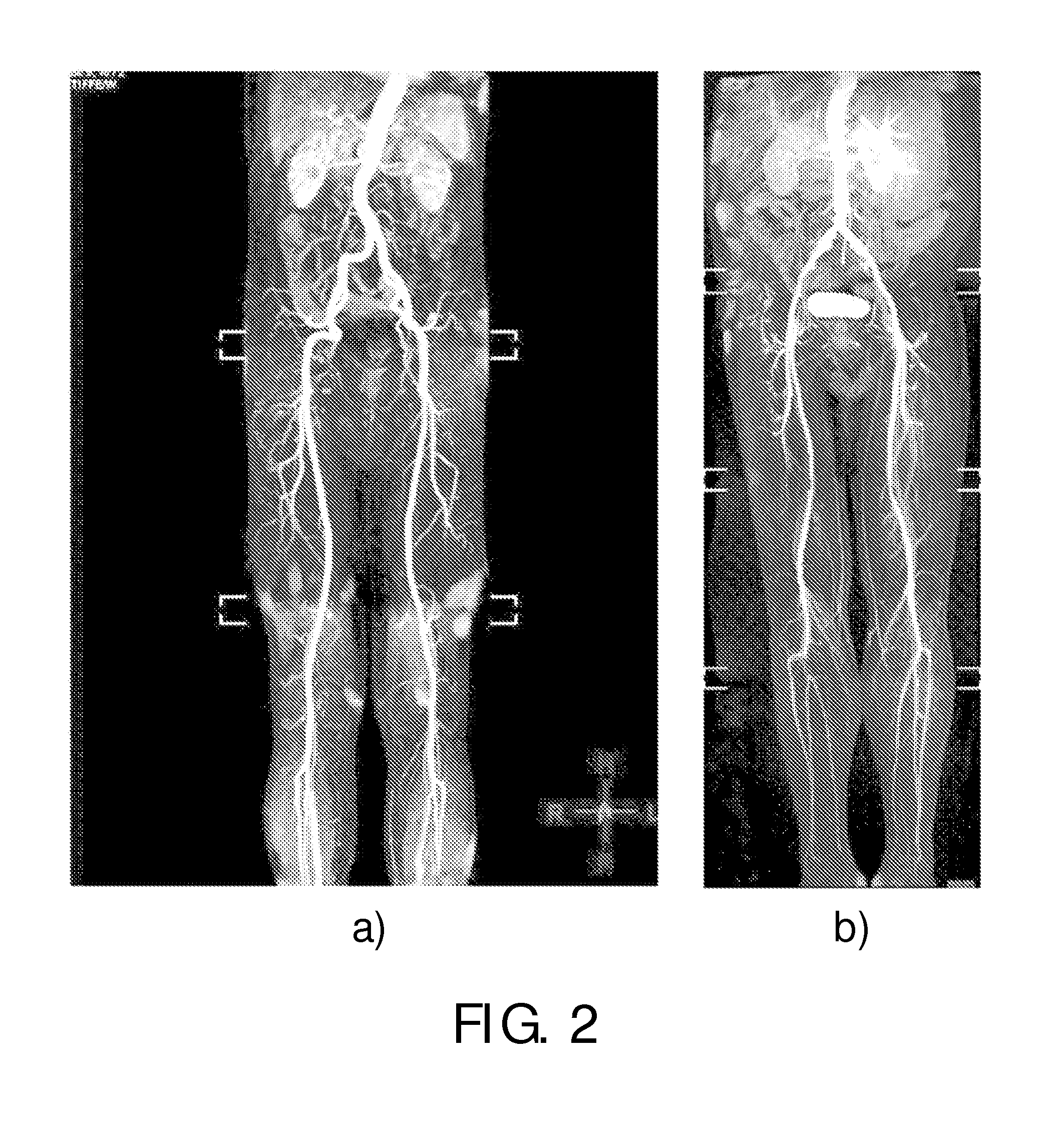 Contrast enhanced magnetic resonance angiography with chemical shift encoding for fat suppression