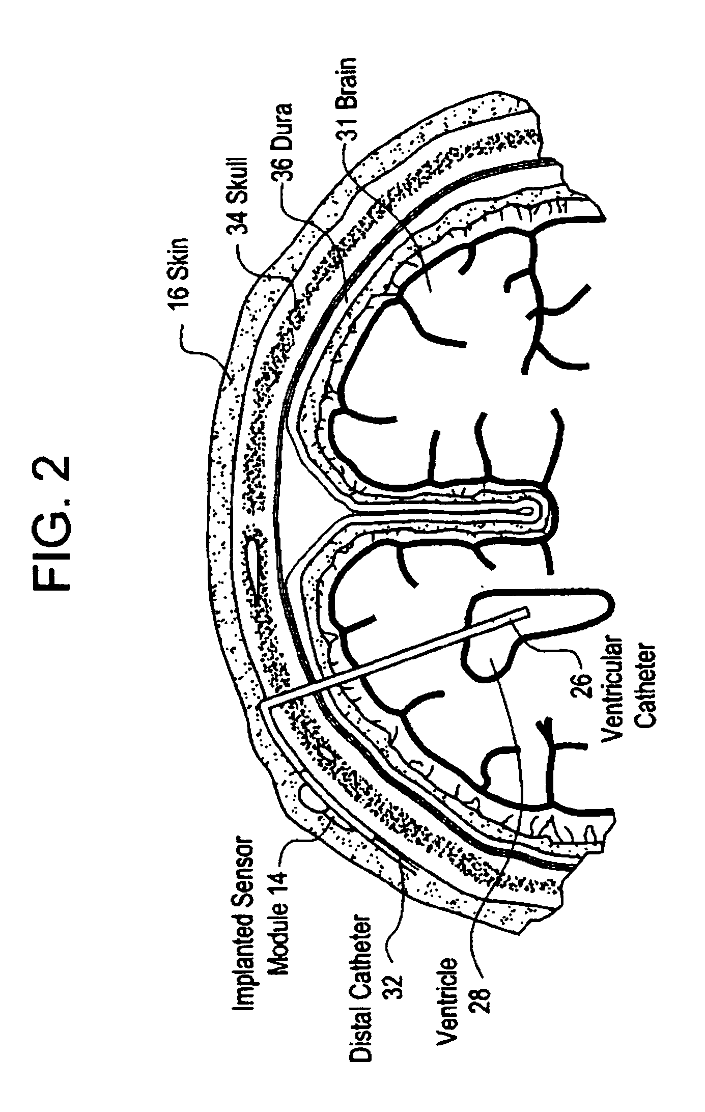 System for transcutaneous monitoring of intracranial pressure