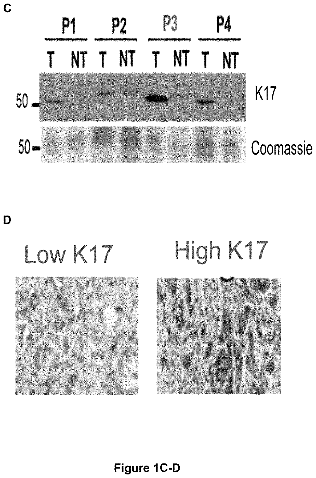 Keratin 17 as a prognostic marker for pancreatic cancer