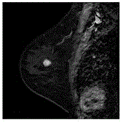 Method and device for judging good and bad breast lumps