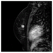 Method and device for judging good and bad breast lumps