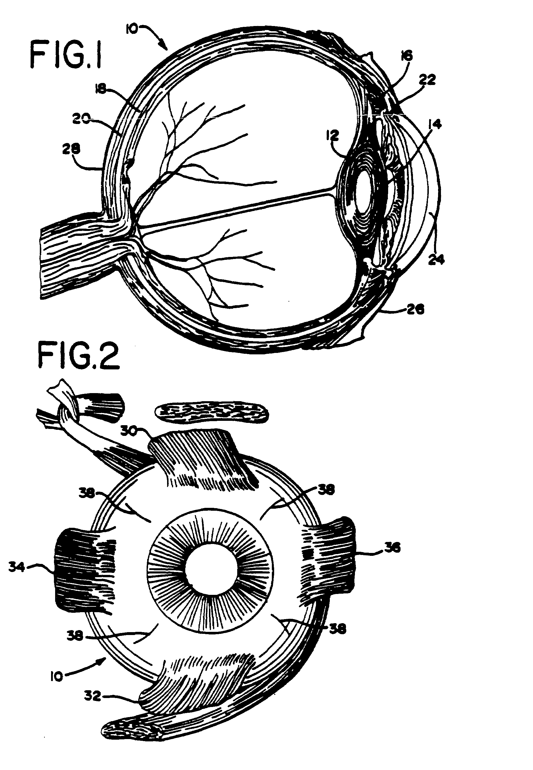 Scleral clip and procedures for using same