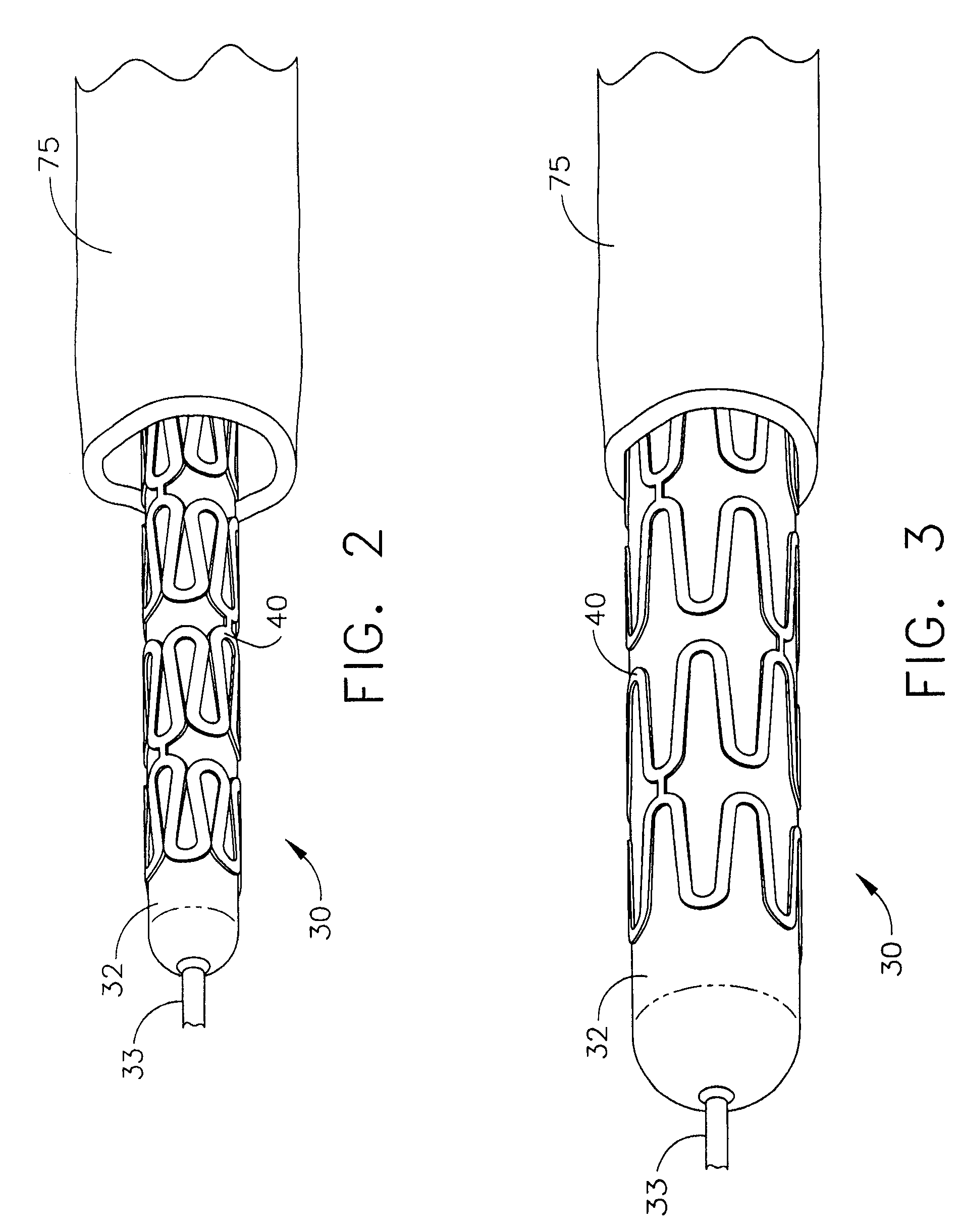 Method of Performing An End-to-End Anastomosis Using a Stent and an Adhesive