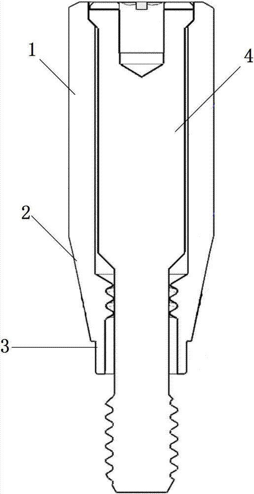 Dental chair-side implant restoration digitization implementation method