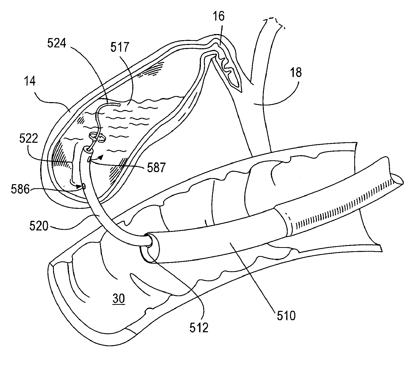 Applicator for endoscopic treatment of biliary disease