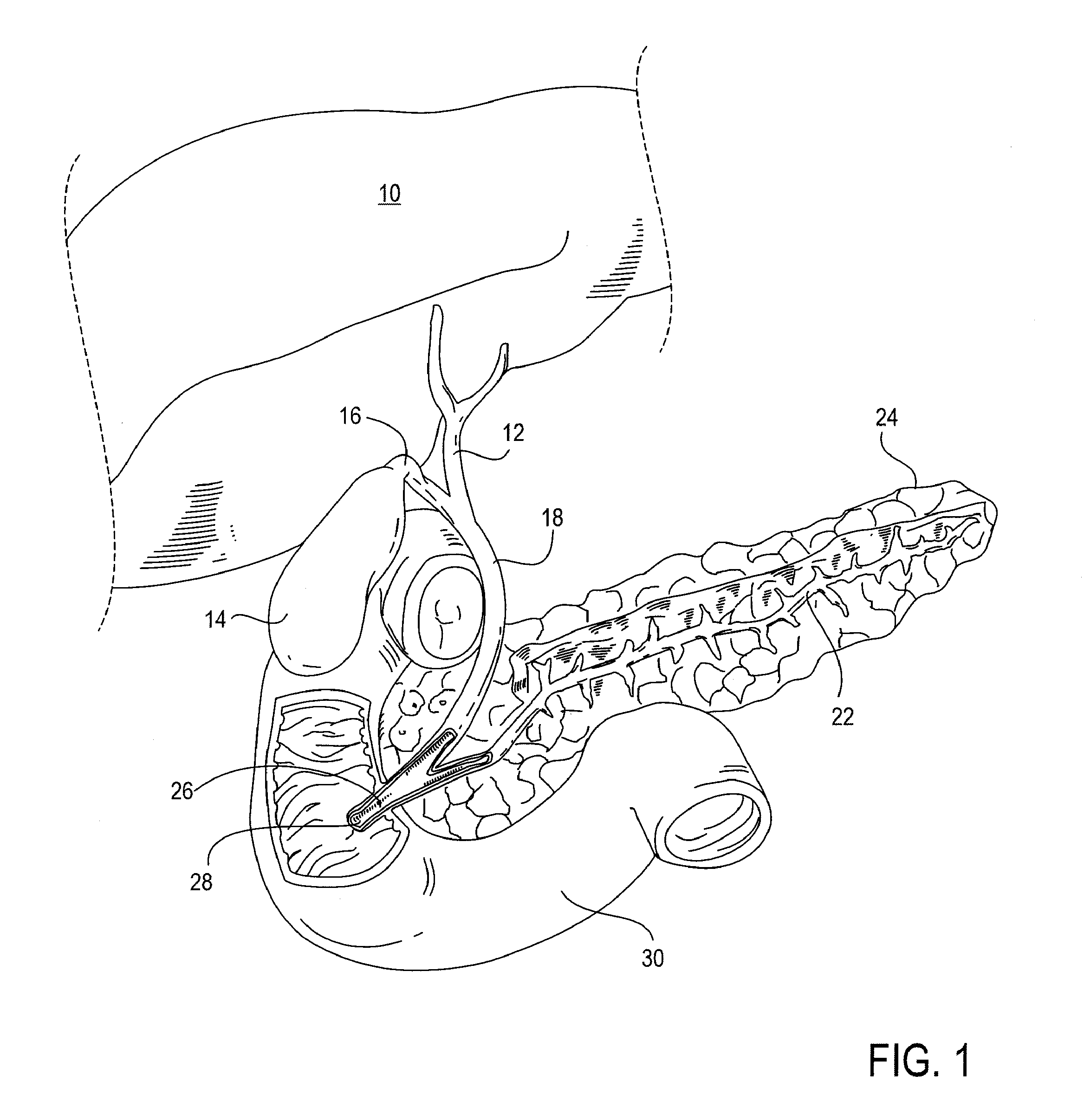 Applicator for endoscopic treatment of biliary disease