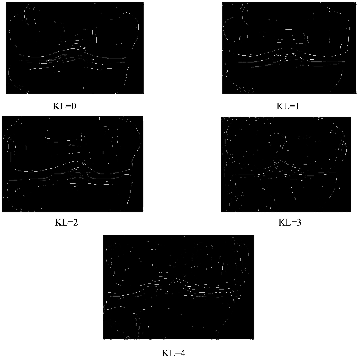 Bone joint X-ray film automatic identification and grading method