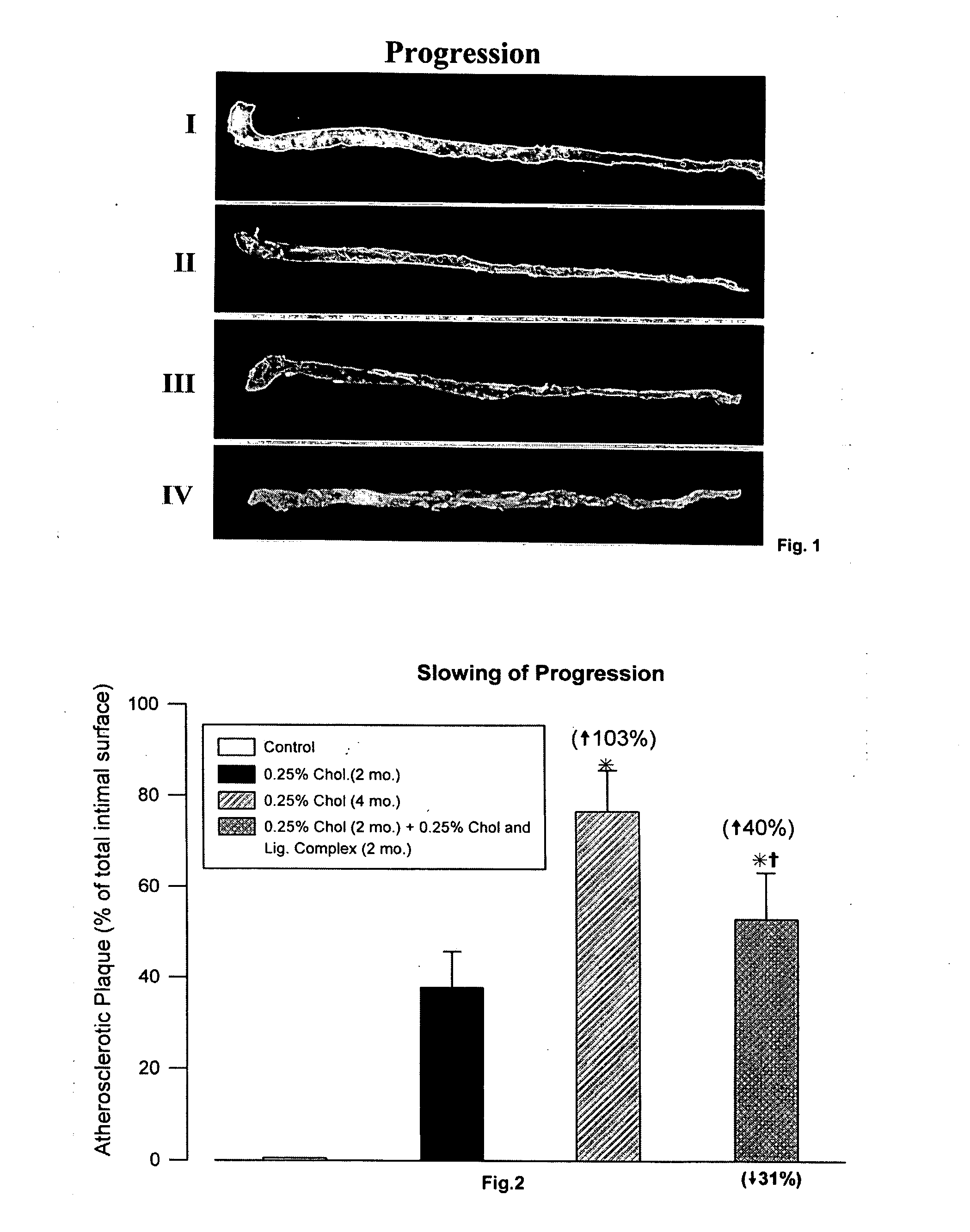 Lignan complex derived from flax seed used for treatment of hypercholesterolemic atherosclerosis