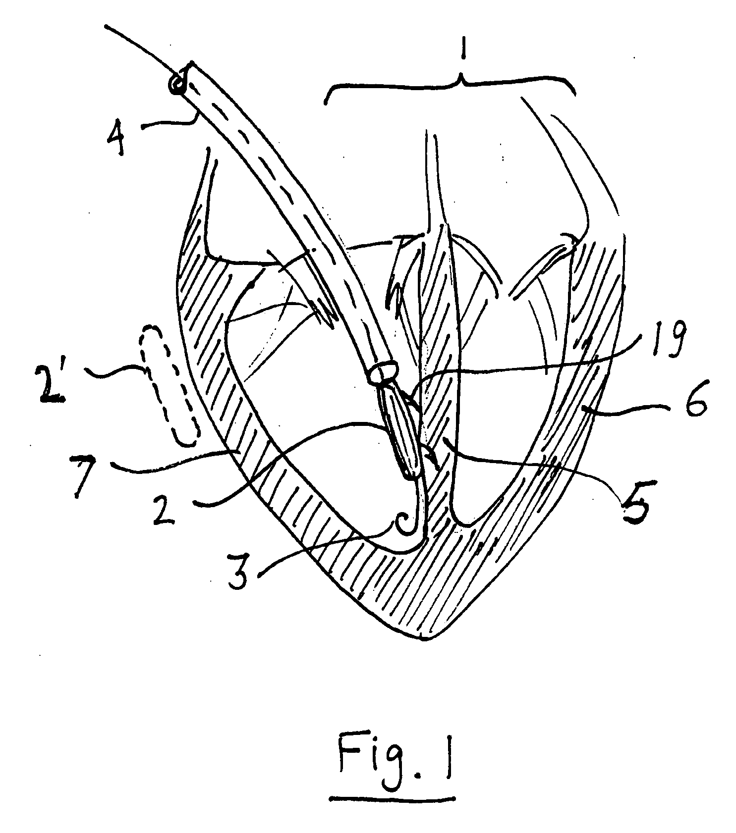 Miniature defibrillator