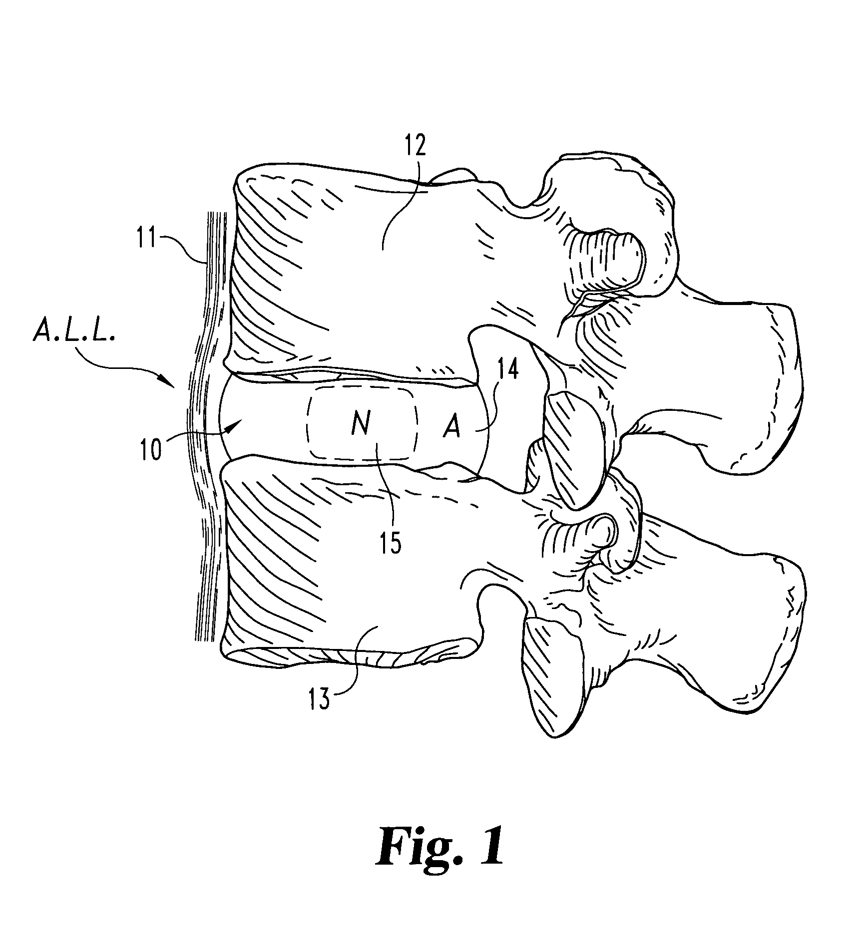 Allogenic/xenogenic implants and methods for augmenting or repairing intervertebral discs