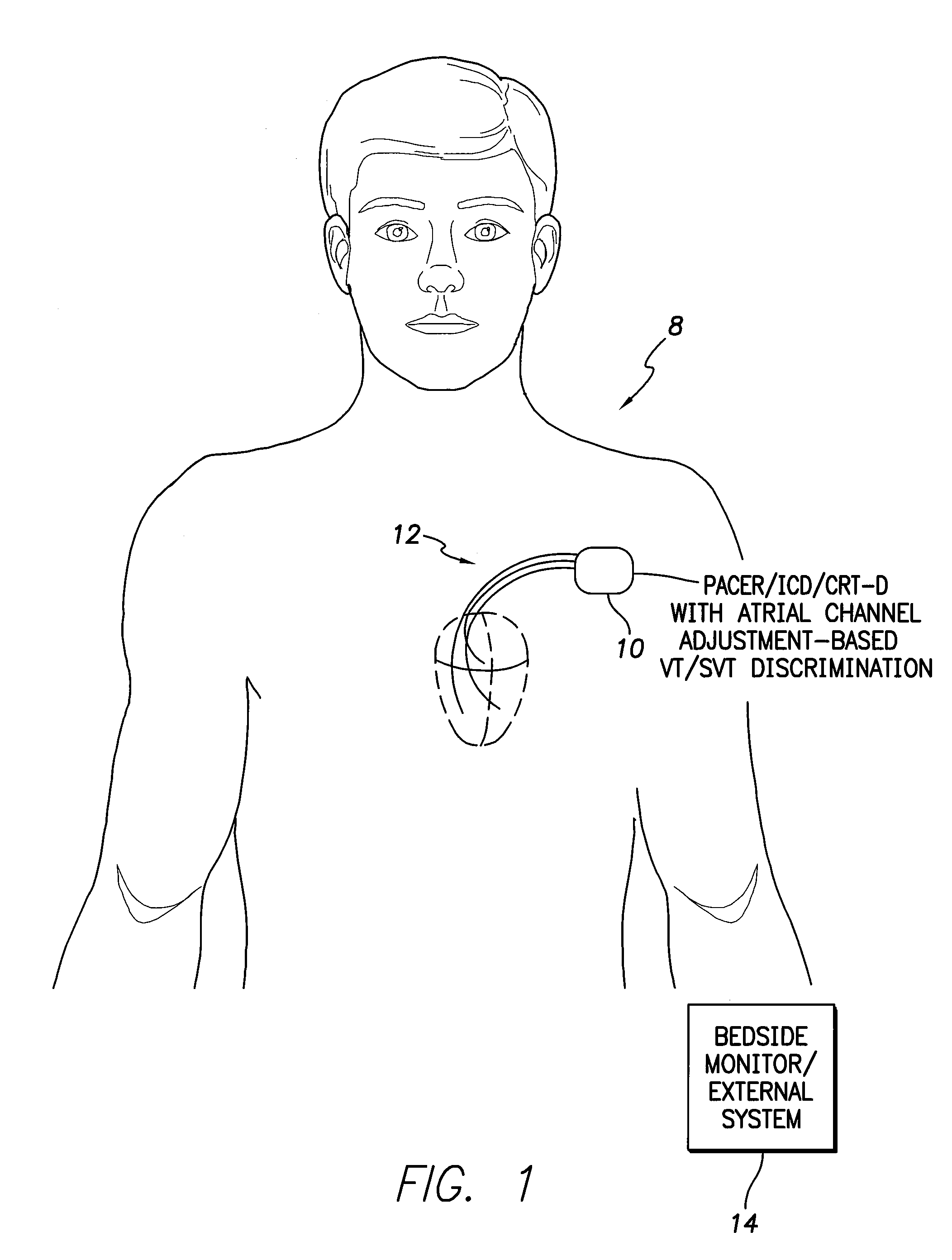 Systems and methods for use with an implantable medical device for discriminating vt and svt be selectively adjusting atrial channel sensing parameters