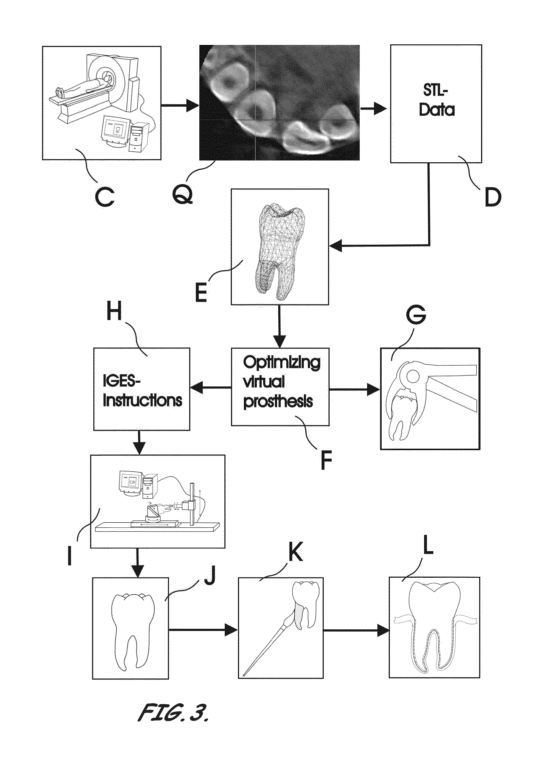 Dental Implant Assembly, Implant, and Prosthesis to Replace a Nonfunctional Natural Tooth and Related Methods