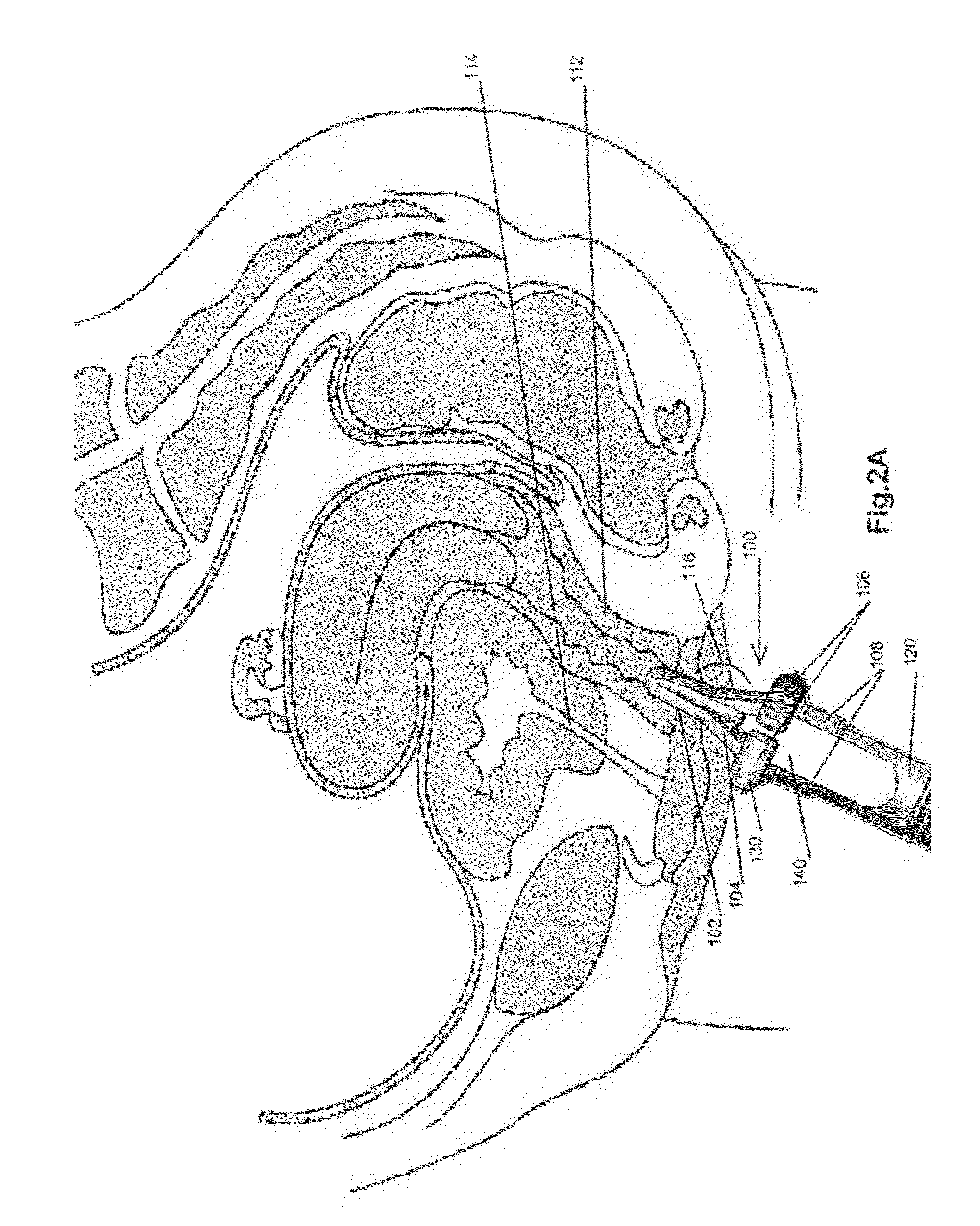 Female urinary incontinence devices