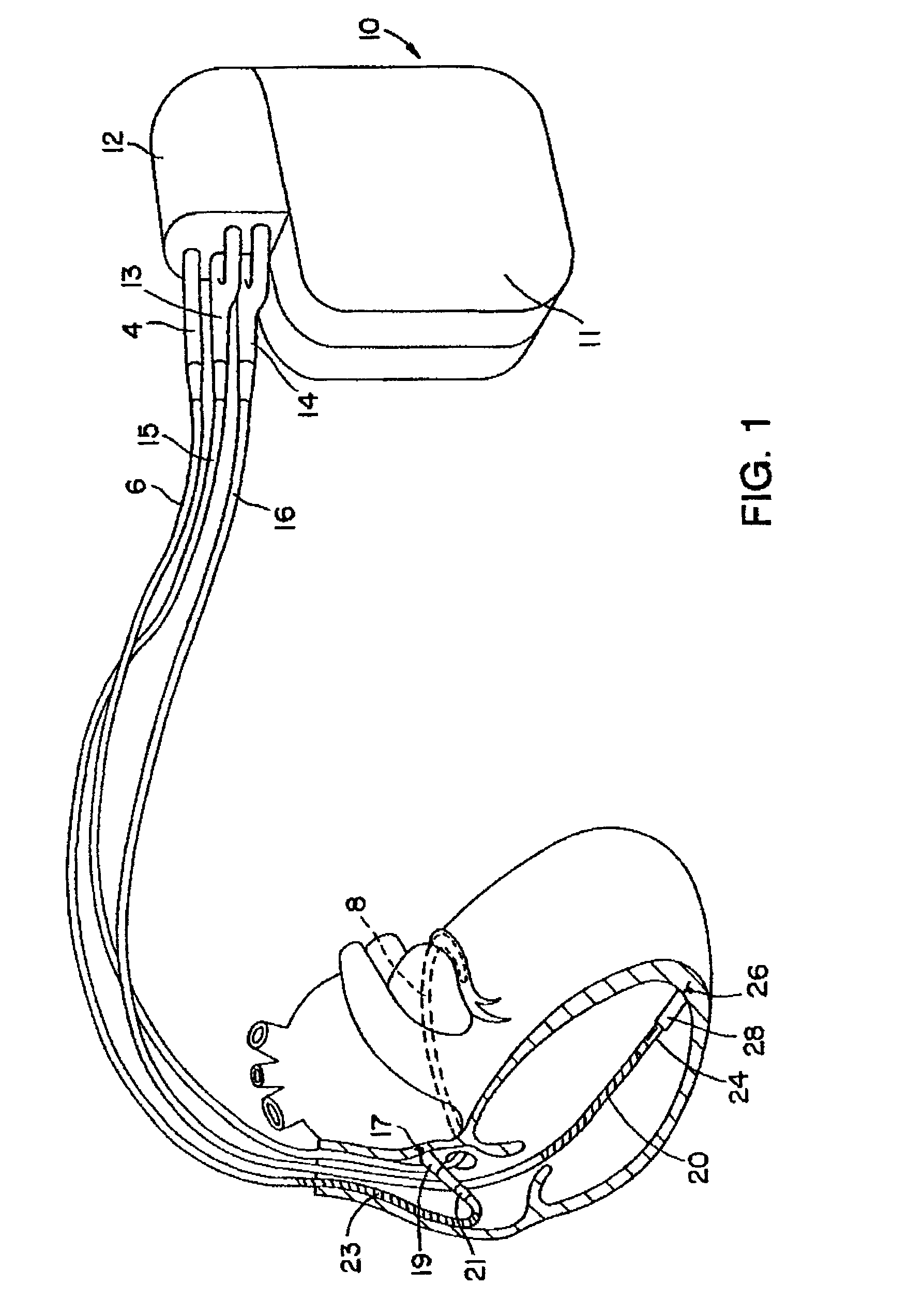 Method for determining a metric of non-sustained arrhythmia occurrence for use in arrhythmia prediction and automatic adjustment of arrhythmia detection parameters