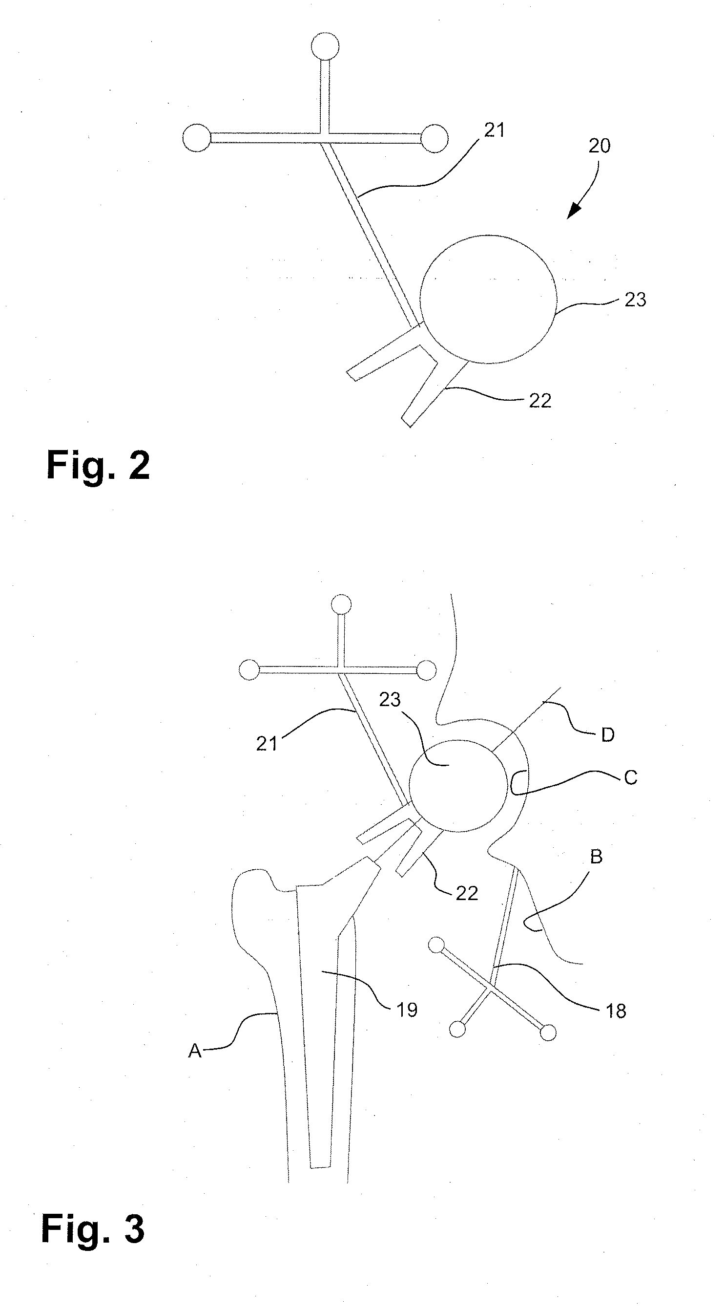 Hip replacement in computer-assisted surgery