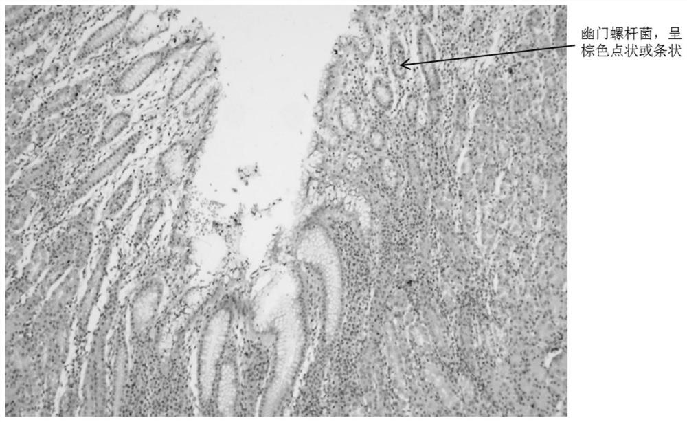 Helicobacter pylori staining kit and application