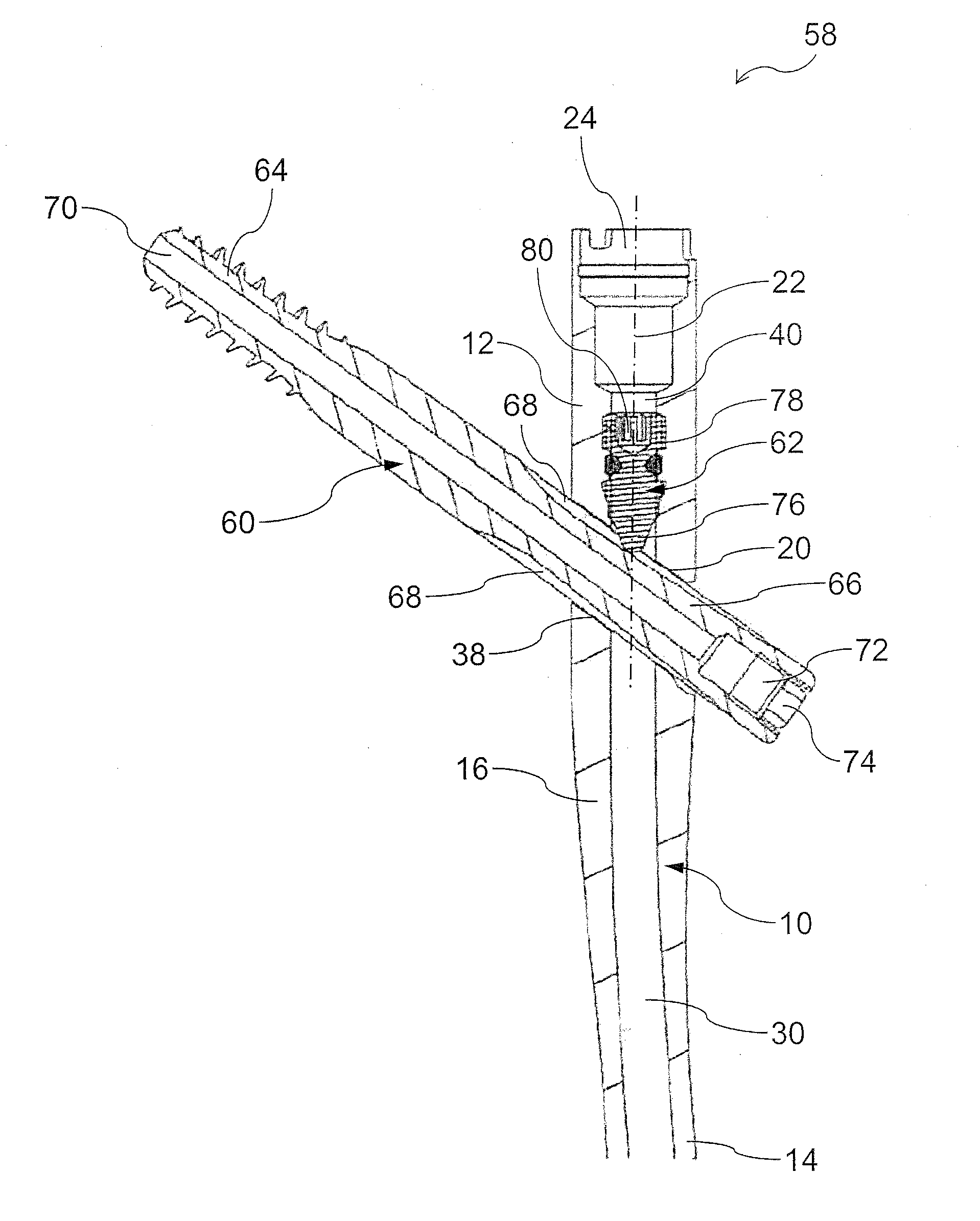 Intramedullary nail and implant system comprising the nail