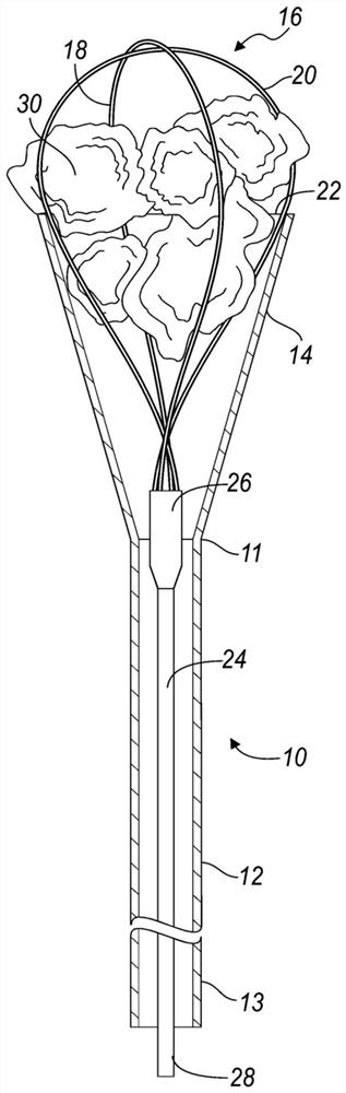 medical device used to capture stone fragments