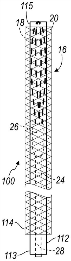 medical device used to capture stone fragments