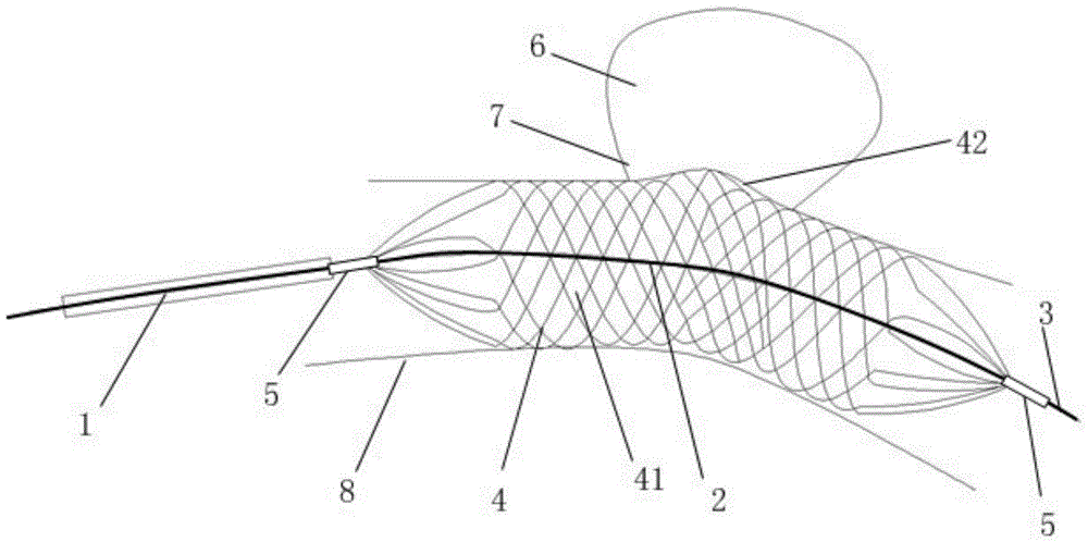 Auxiliary embolization device for aneurysm neck