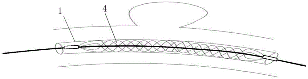 Auxiliary embolization device for aneurysm neck