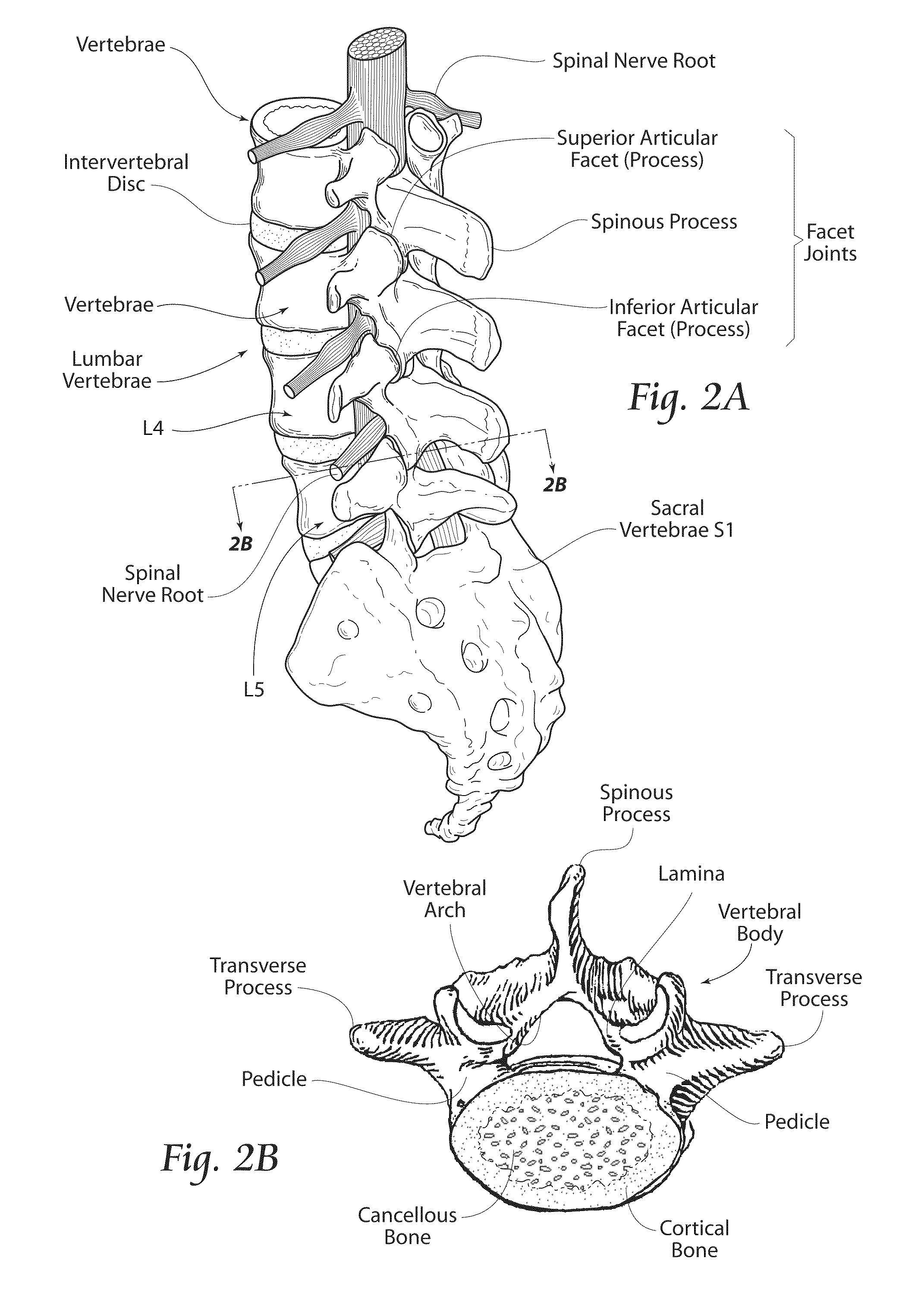 Minimally invasive systems, devices, and surgical methods for performing arthrodesis in the spine