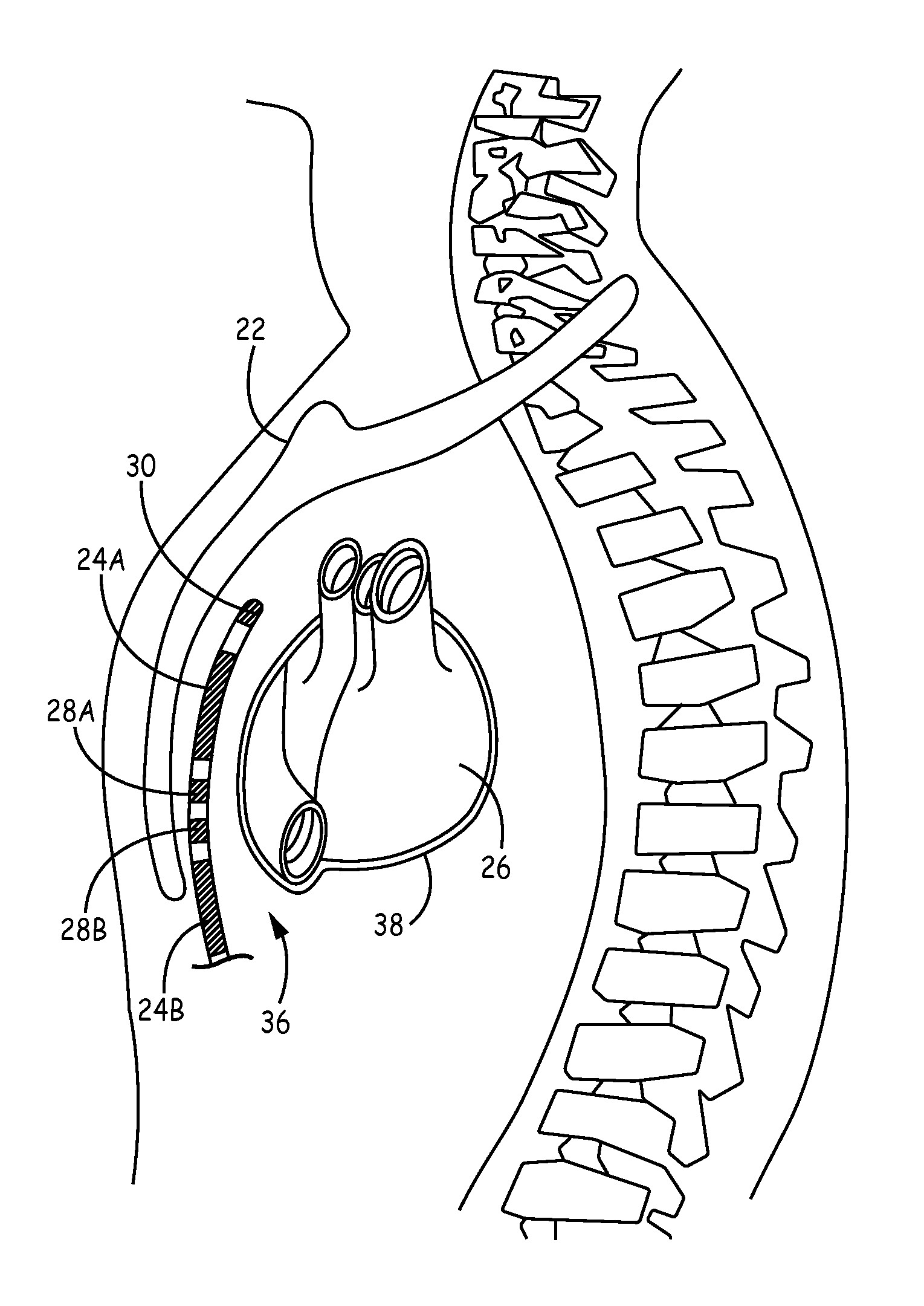 Implantable extravascular electrical stimulation lead having improved sensing and pacing capability