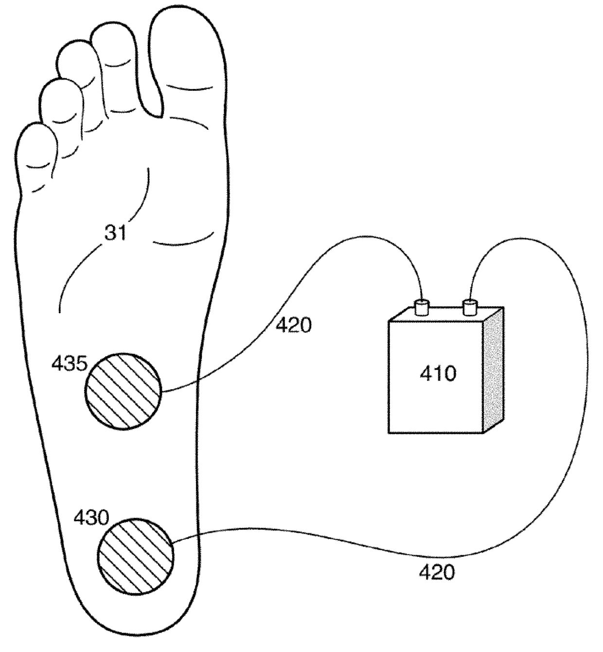 Method and apparatus for noninvasive inhibition of deep vein thrombosis