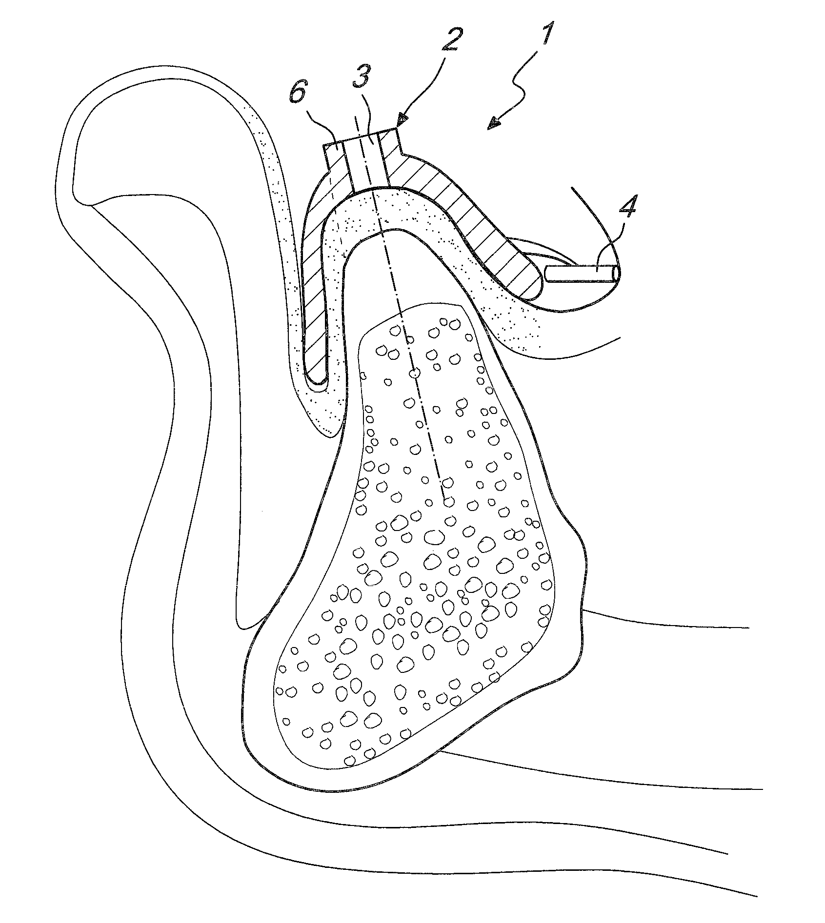 Surgical drill templates and methods of manufacturing the same