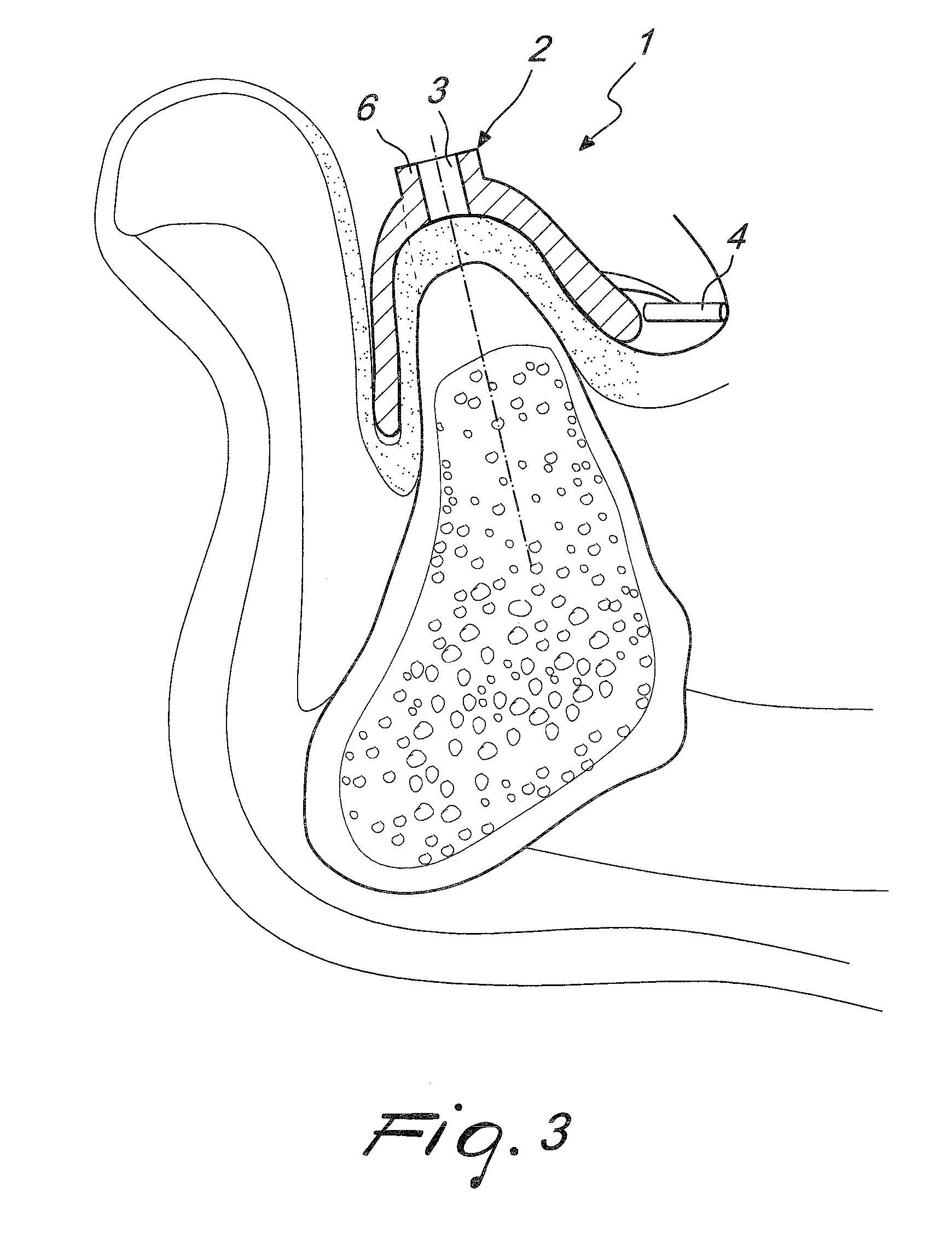 Surgical drill templates and methods of manufacturing the same