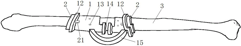 Fibula cutting shaping positioner through 3D printing