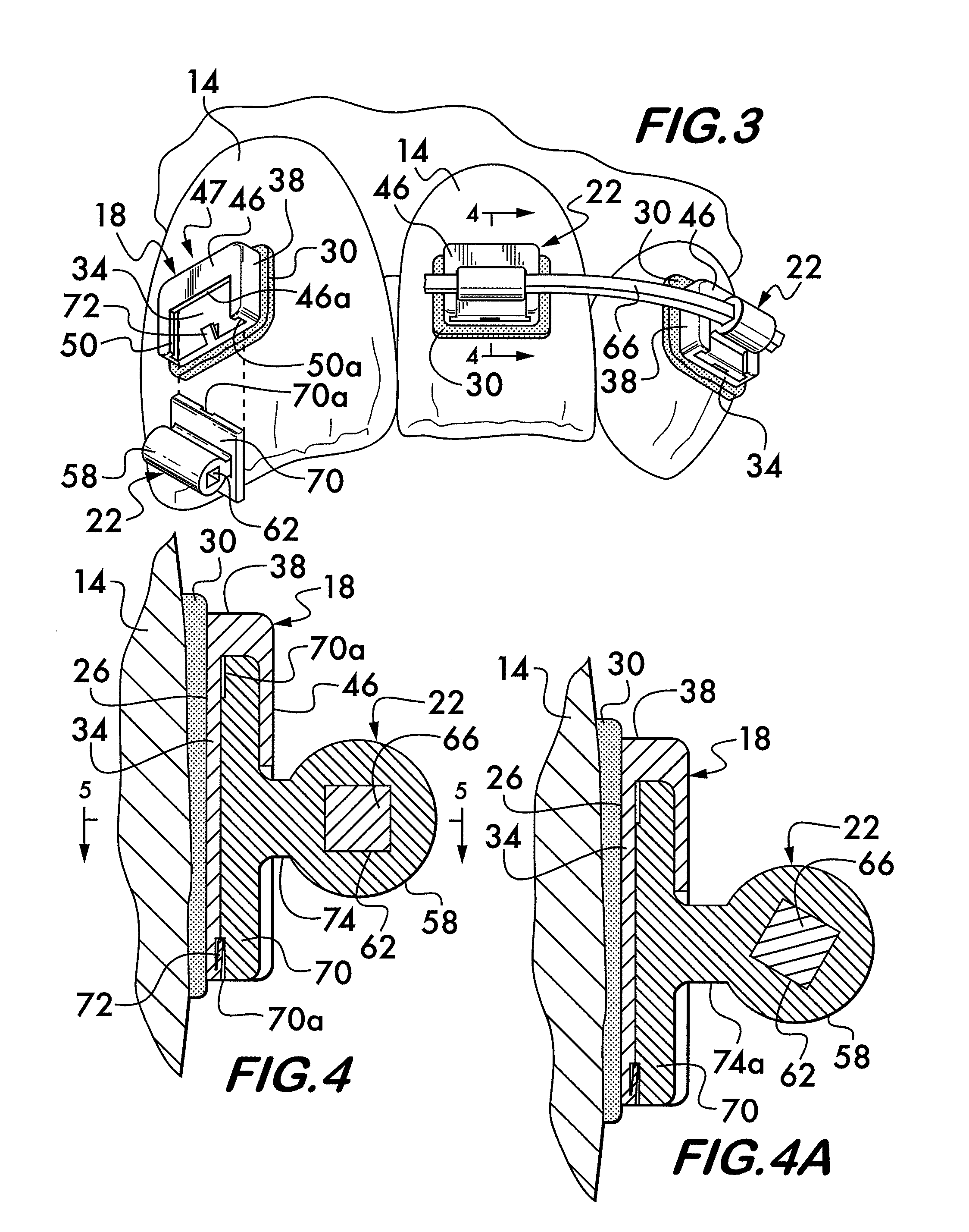 Multi-component orthodontic bracket assembly