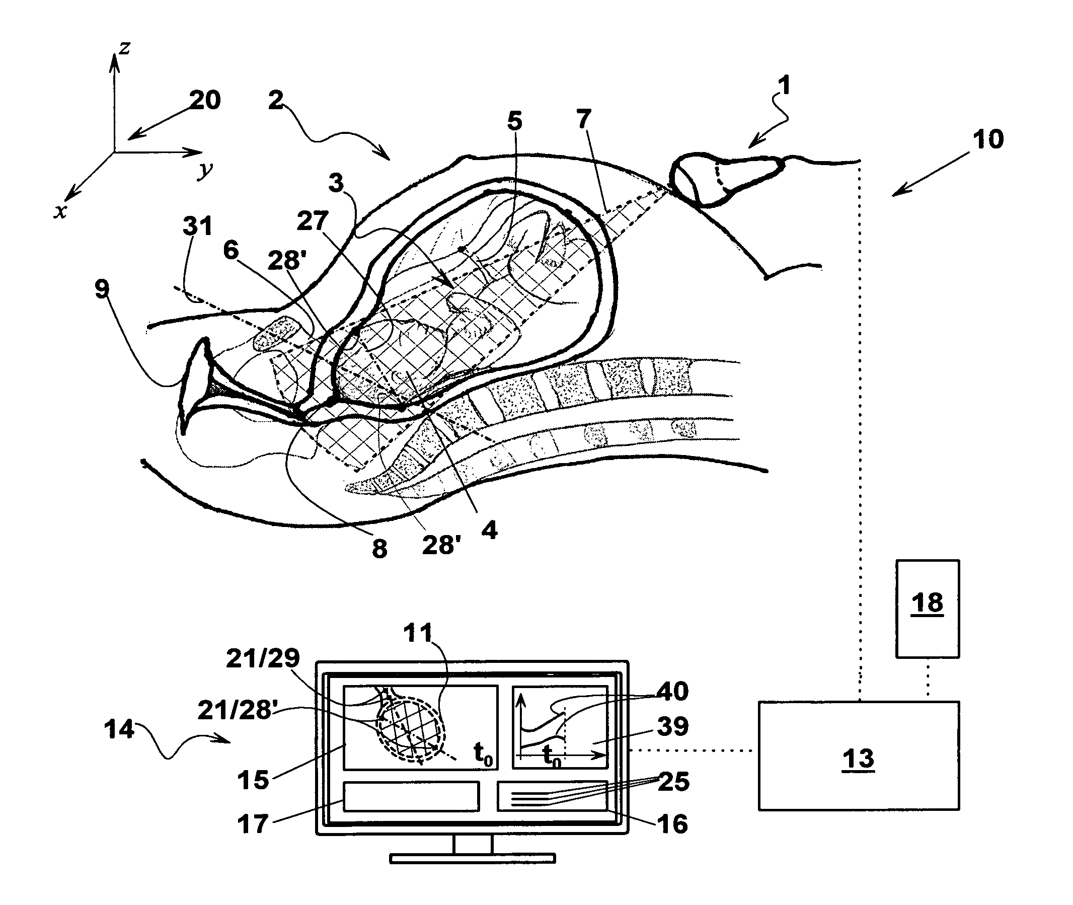 Ultrasonic apparatus for measuring a labor progress parameter